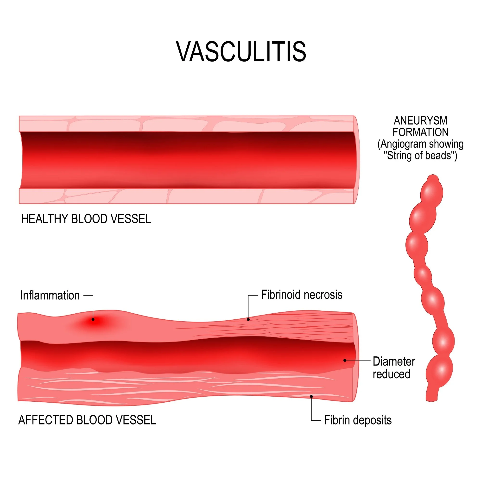 What Is Autoimmune Inflammatory Vasculitis