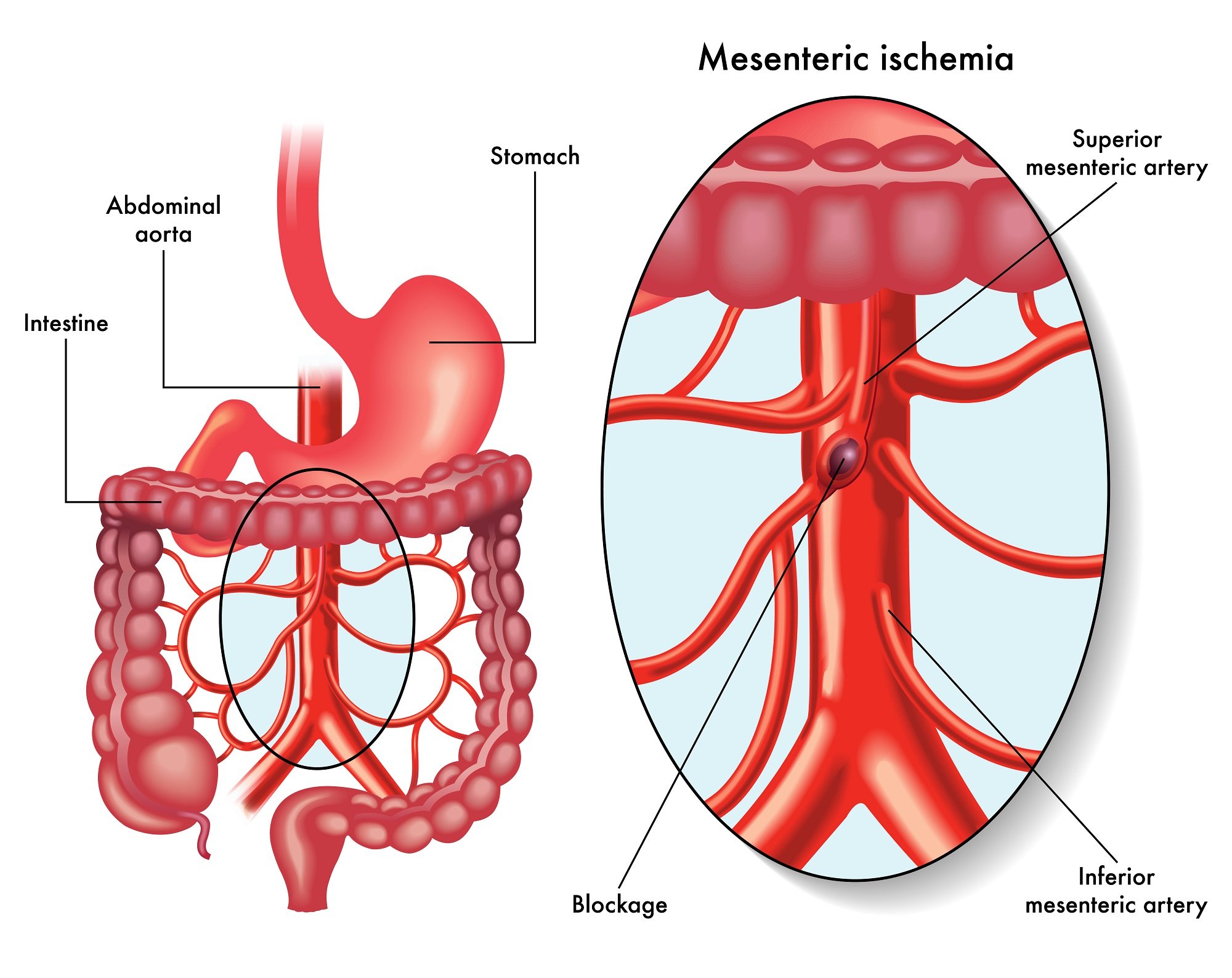 Mesenteric Artery Disease — Vascular Cures