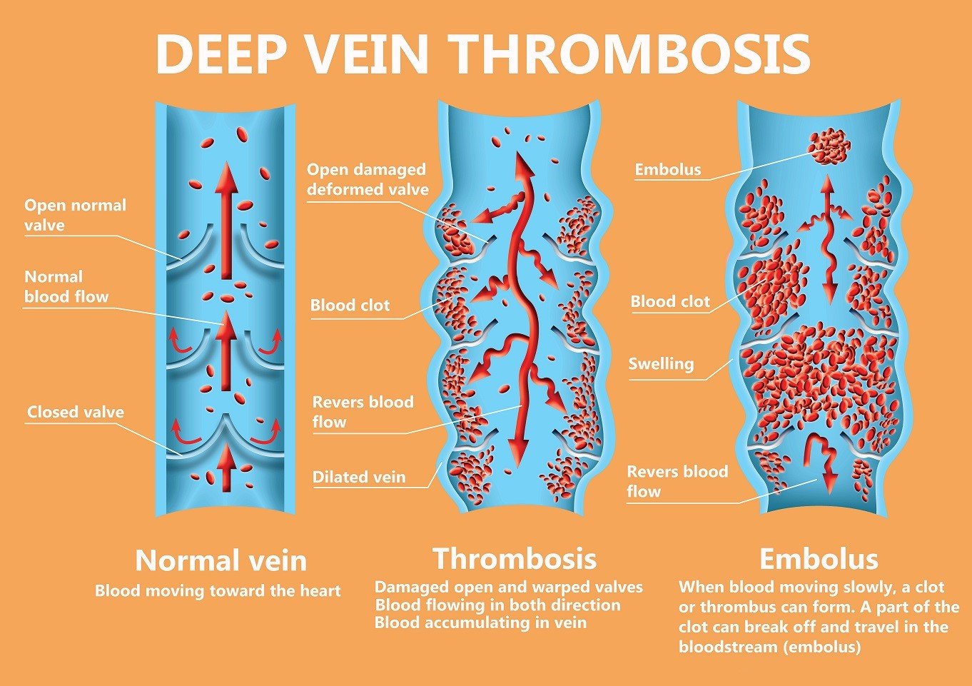 Post Thrombotic Syndrome Vascular Cures post-thrombotic-syndrome-vascular-cures