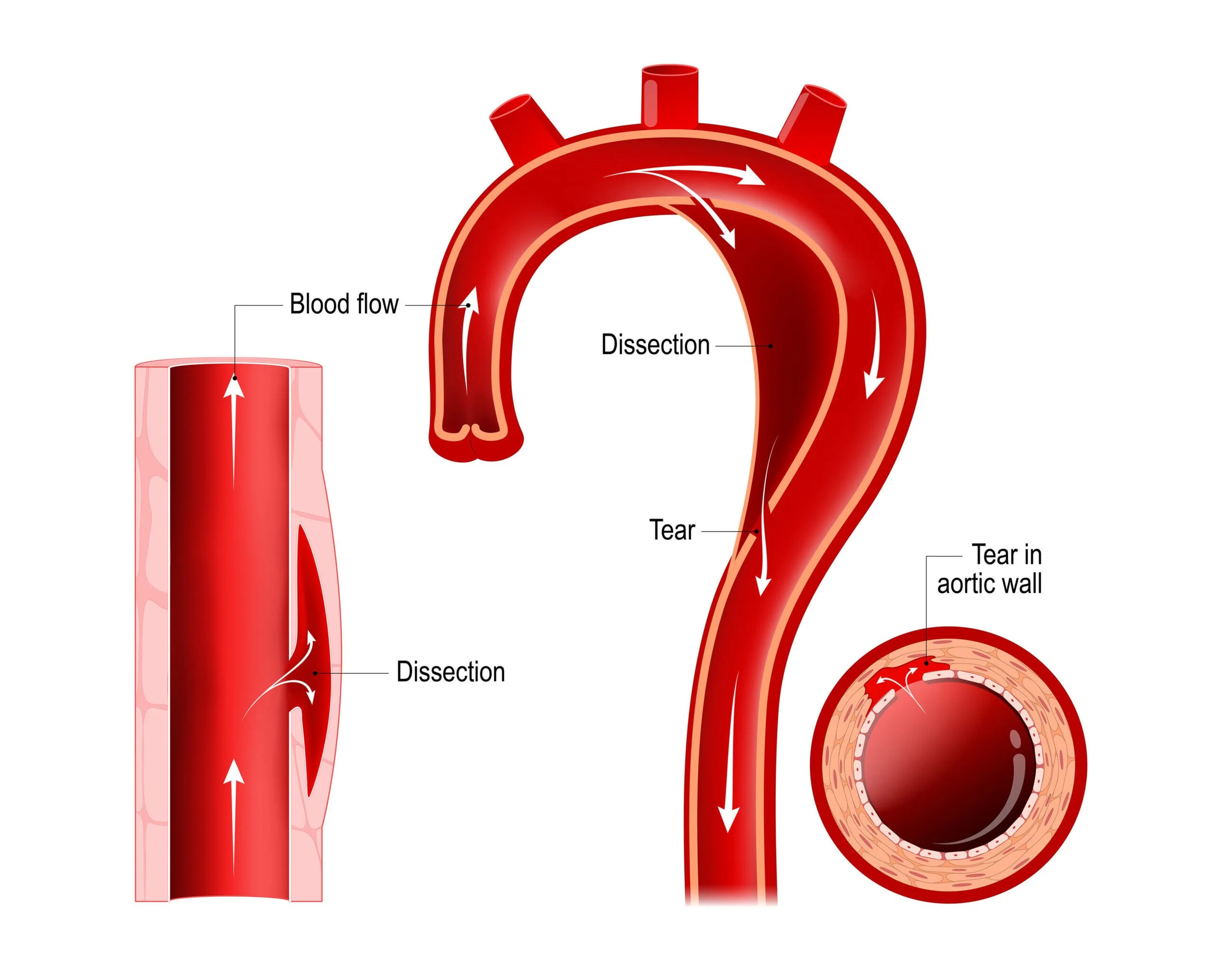 Aortic Dissection (AD) — Vascular Cures