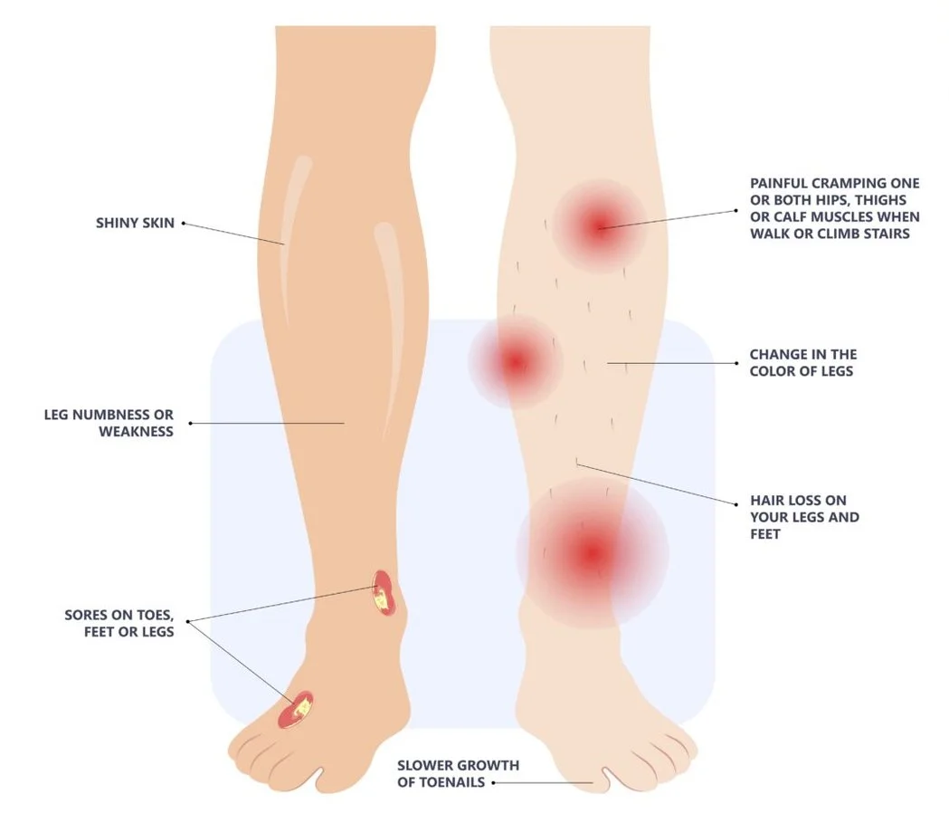 peripheral-artery-disease-the-foundation-to-advance-vascular-cures