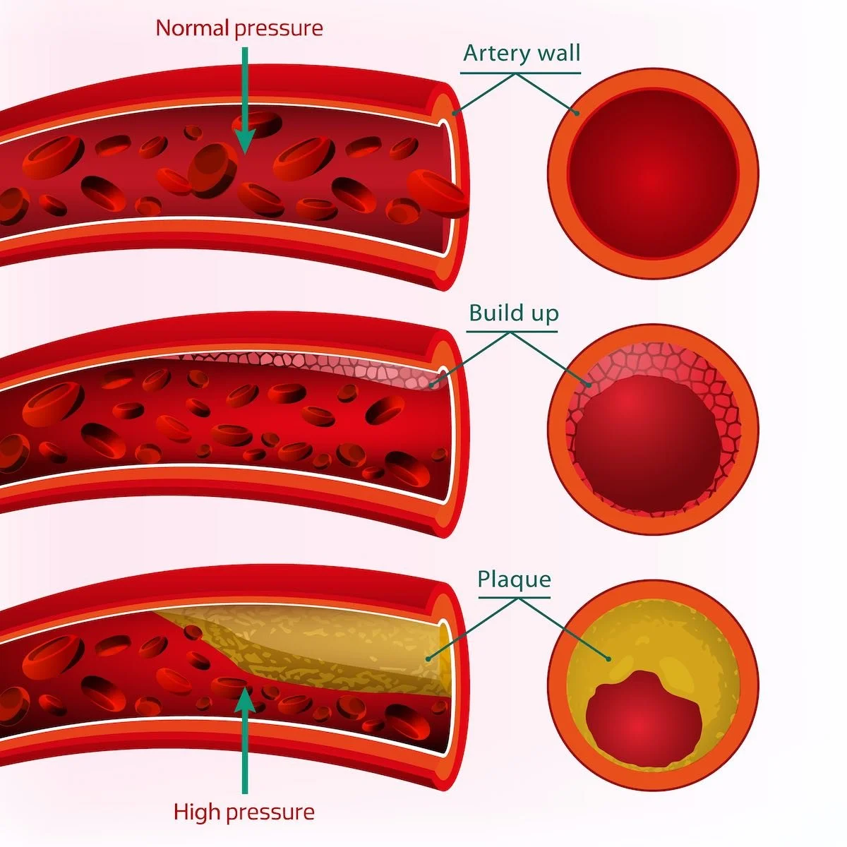 High Blood Pressure and Vascular Disease The Foundation to Advance