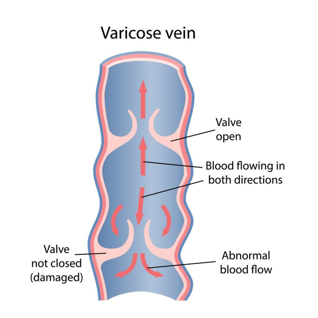 Varicose Vein Graphic