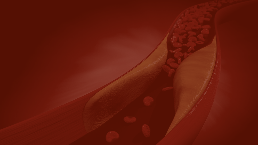 What is Vascular Disease? The Foundation to Advance Vascular Cures