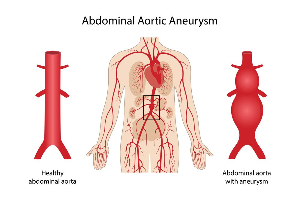 Anévrisme de l'aorte abdominale