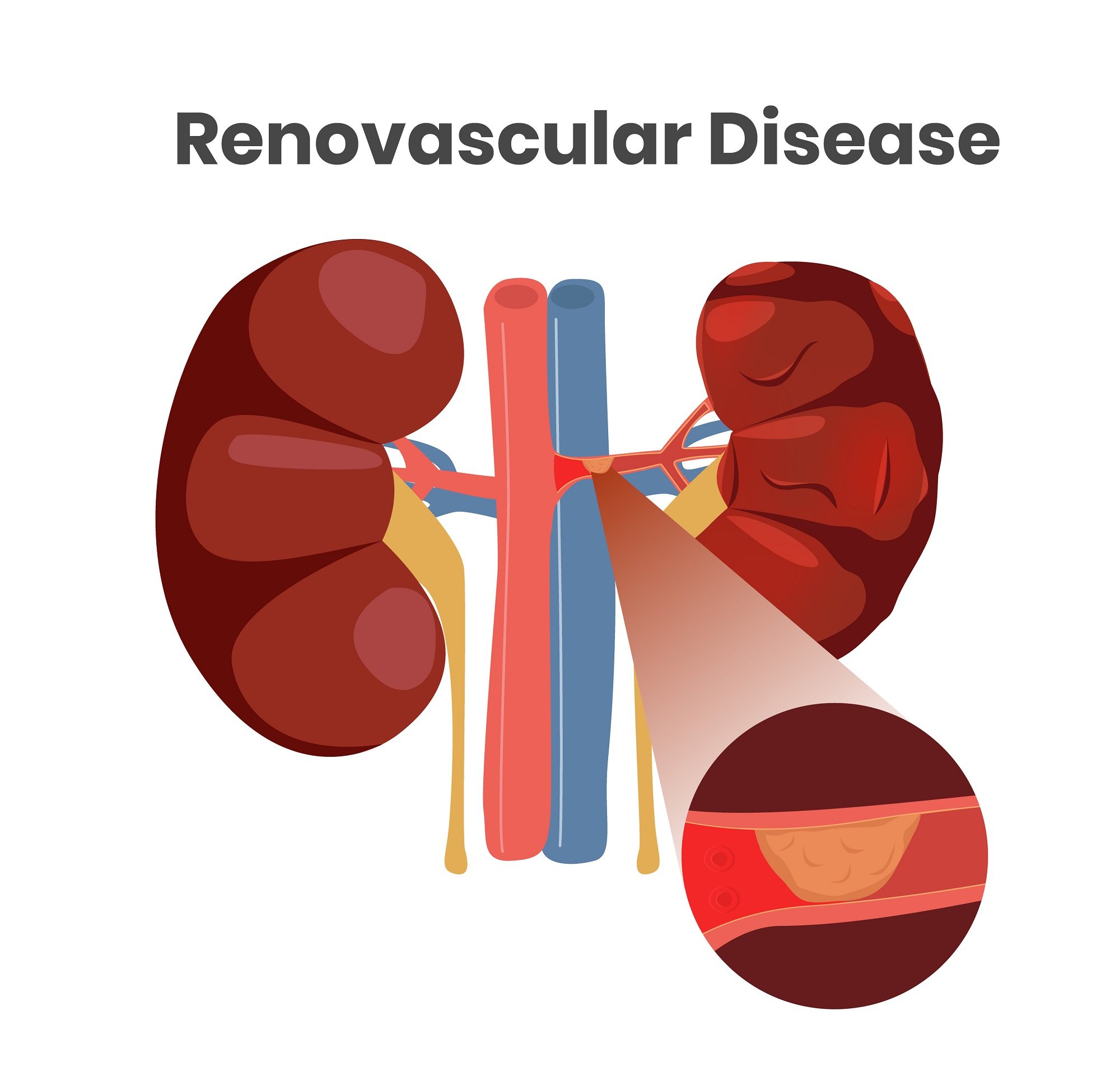 Renovascular Hypertension The Foundation to Advance Vascular Cures
