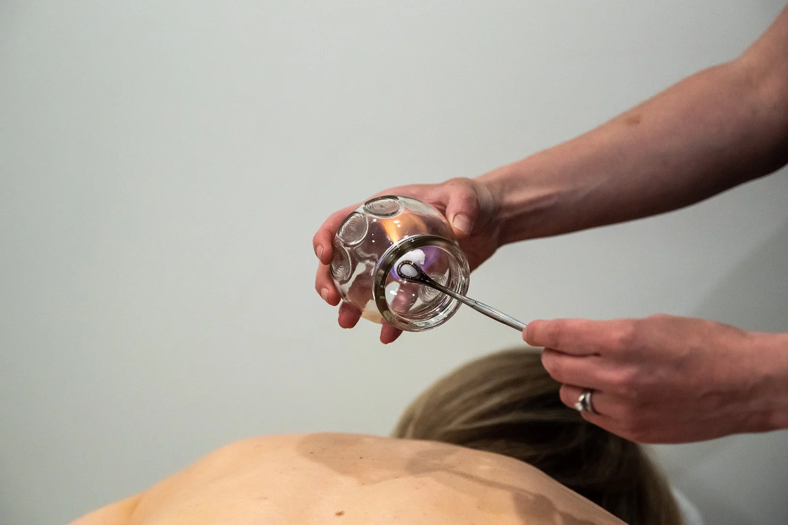 Person holding a glass cupping device and using a metal needle to create suction on the back of a person lying face down.