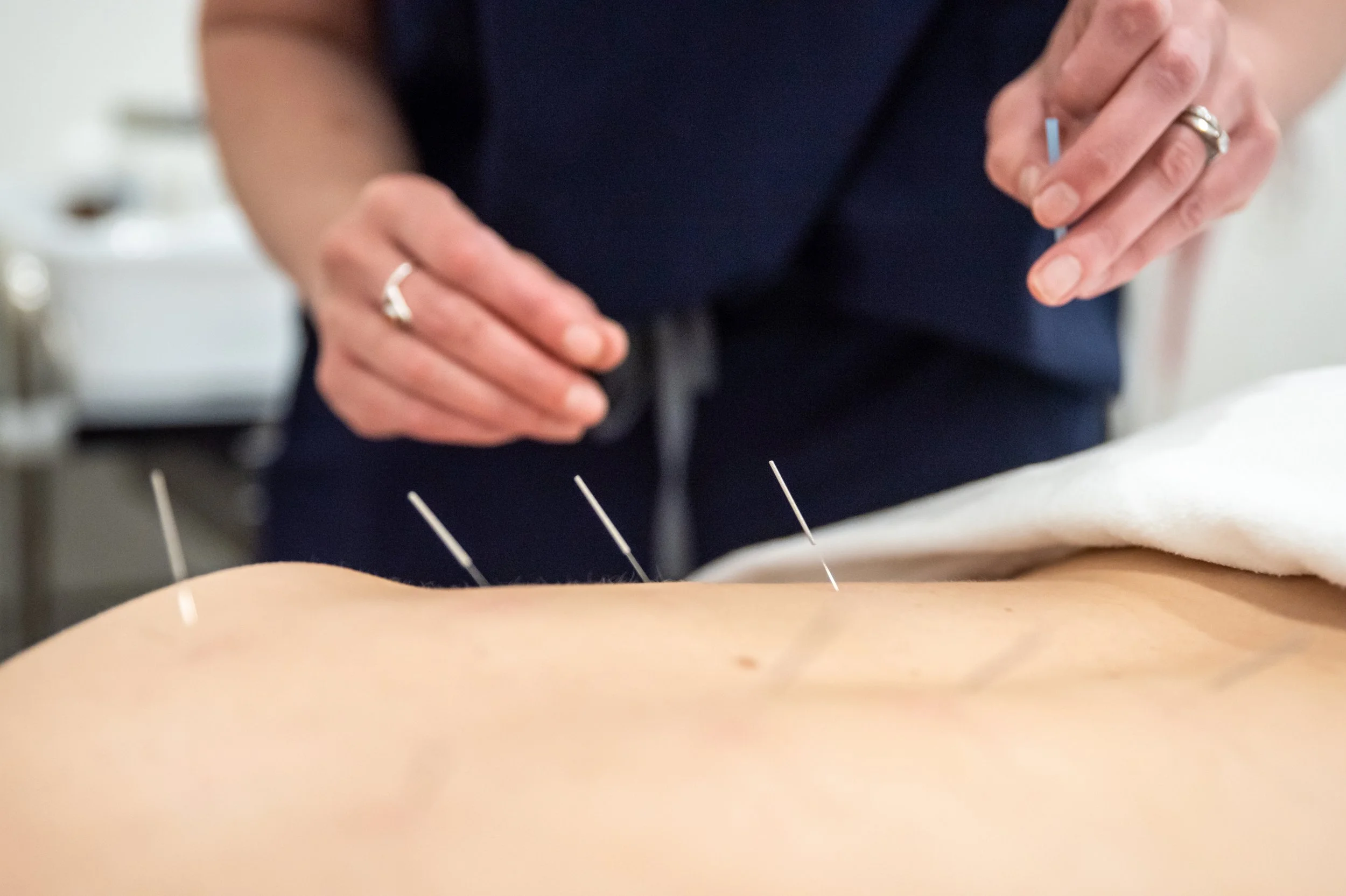 A person performing acupuncture on a person's back, with several acupuncture needles inserted into their skin.