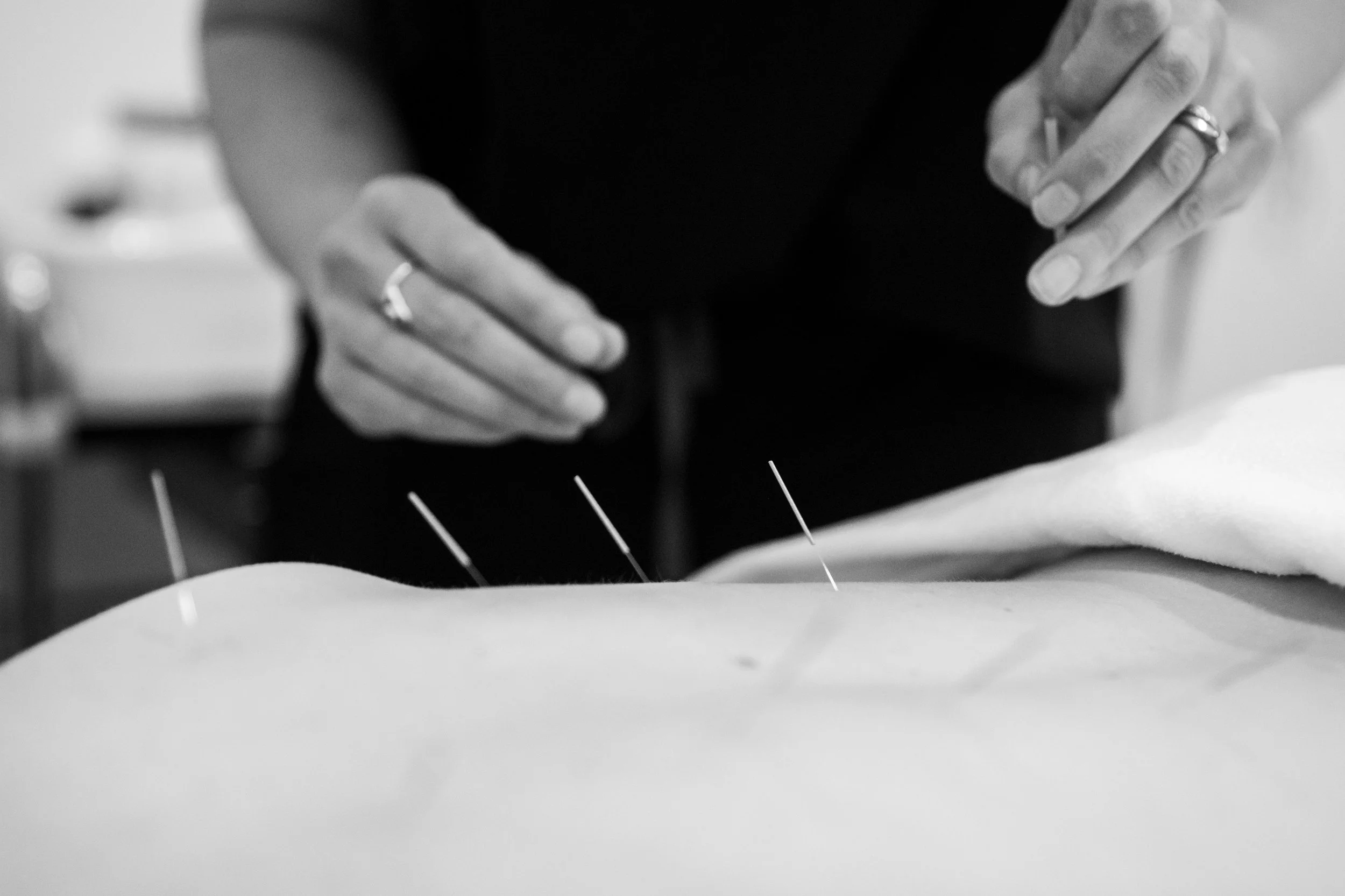 Close-up of a person's hands performing acupuncture on a patient's back, with thin needles inserted into the skin.