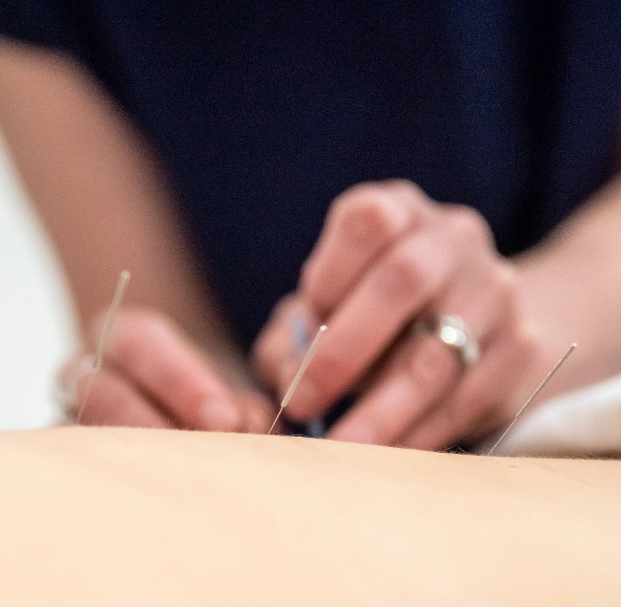 Close-up of a hand holding a cluster of acupuncture needles.