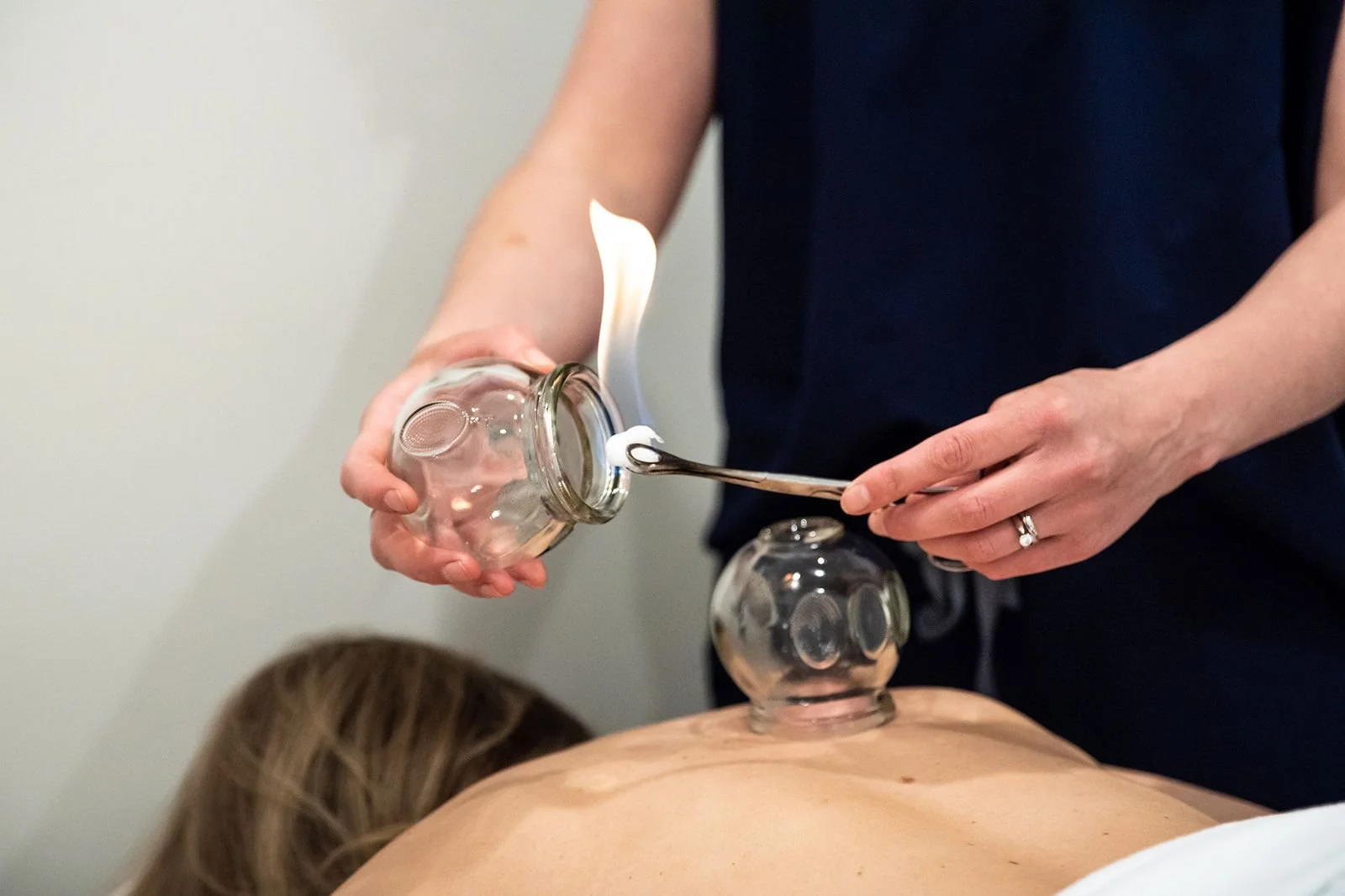 Person performing cupping therapy by applying a flame to a glass cup on a patient's back.