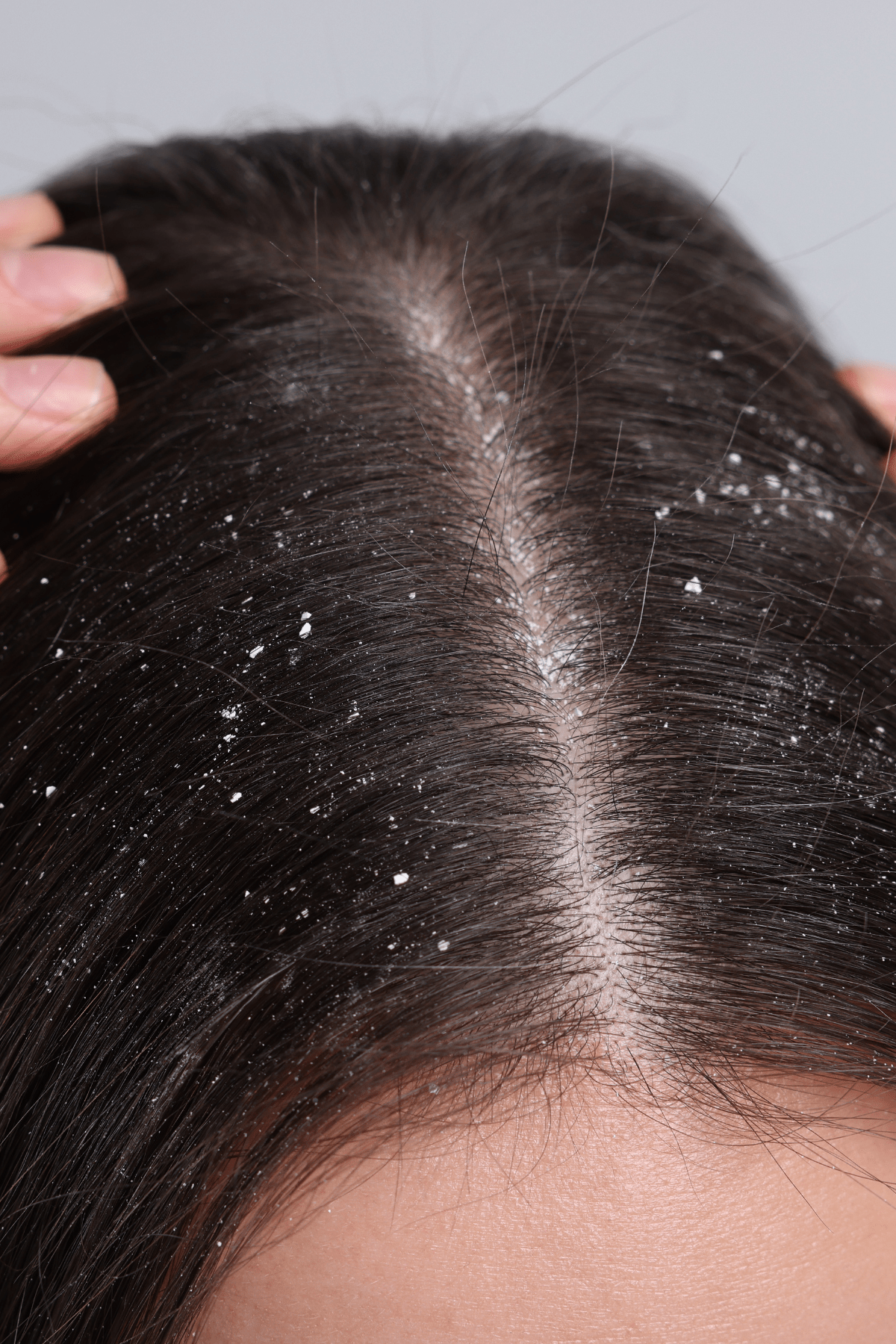 An image of a women with dandruff