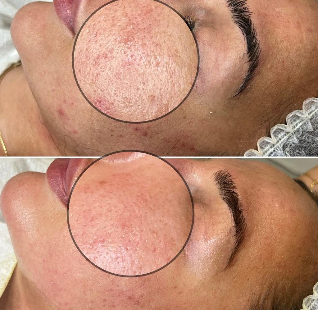 Aqua-Facial Behandlung - Before & after Photo_Jenny Kogles_Beauty and Style