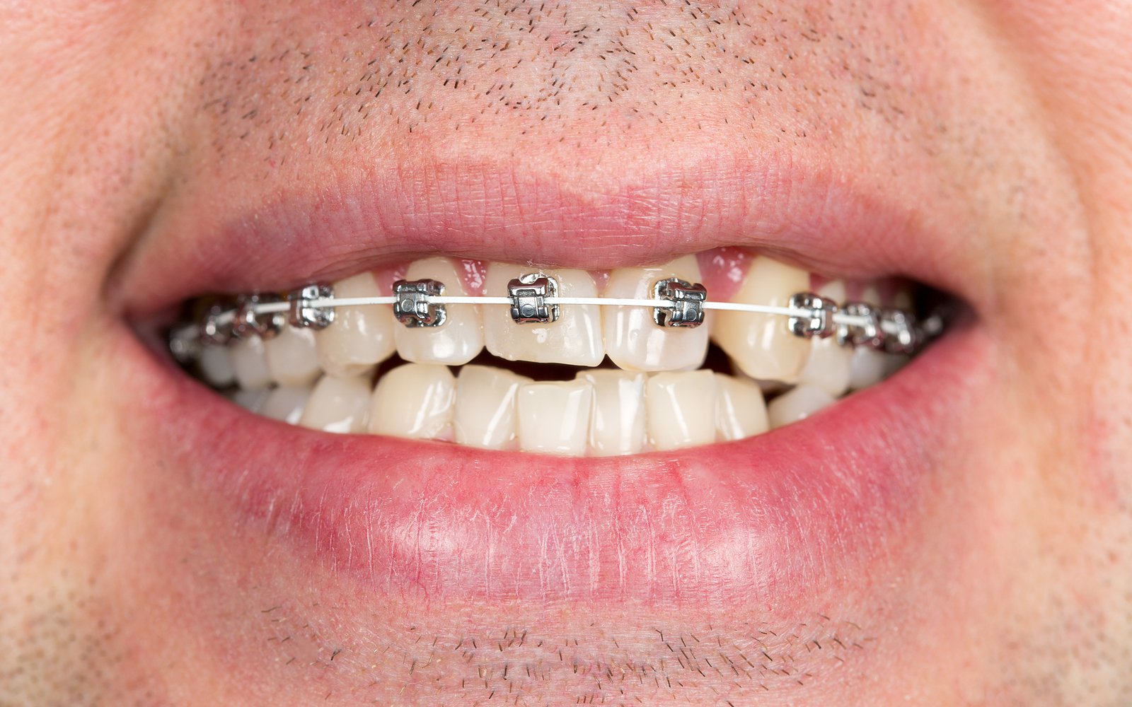 Rubber Bands Braces 101 - Orthodontics Limited