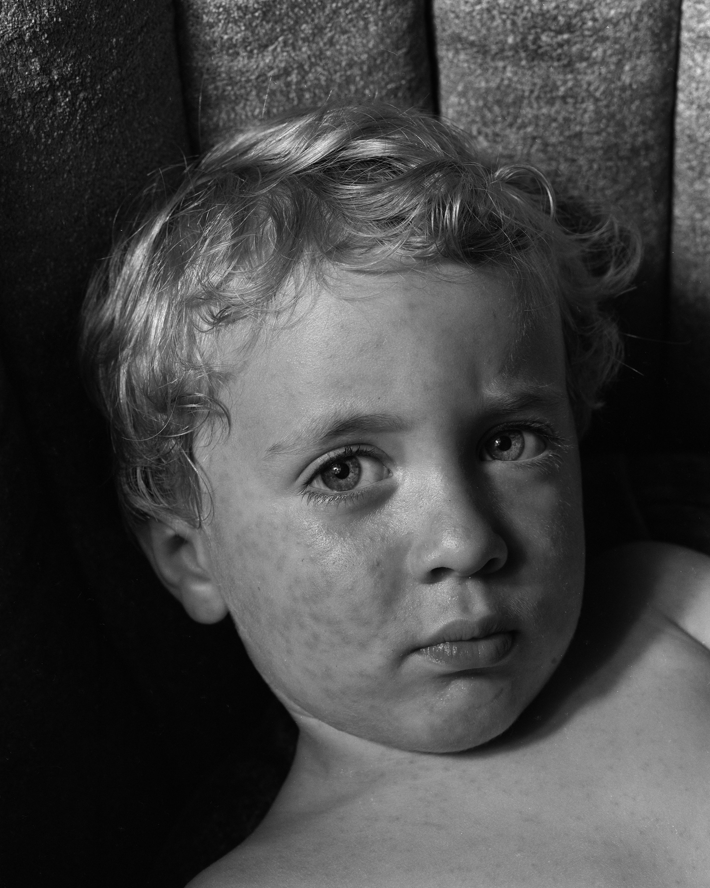 Brady with Skin Rash, 1987