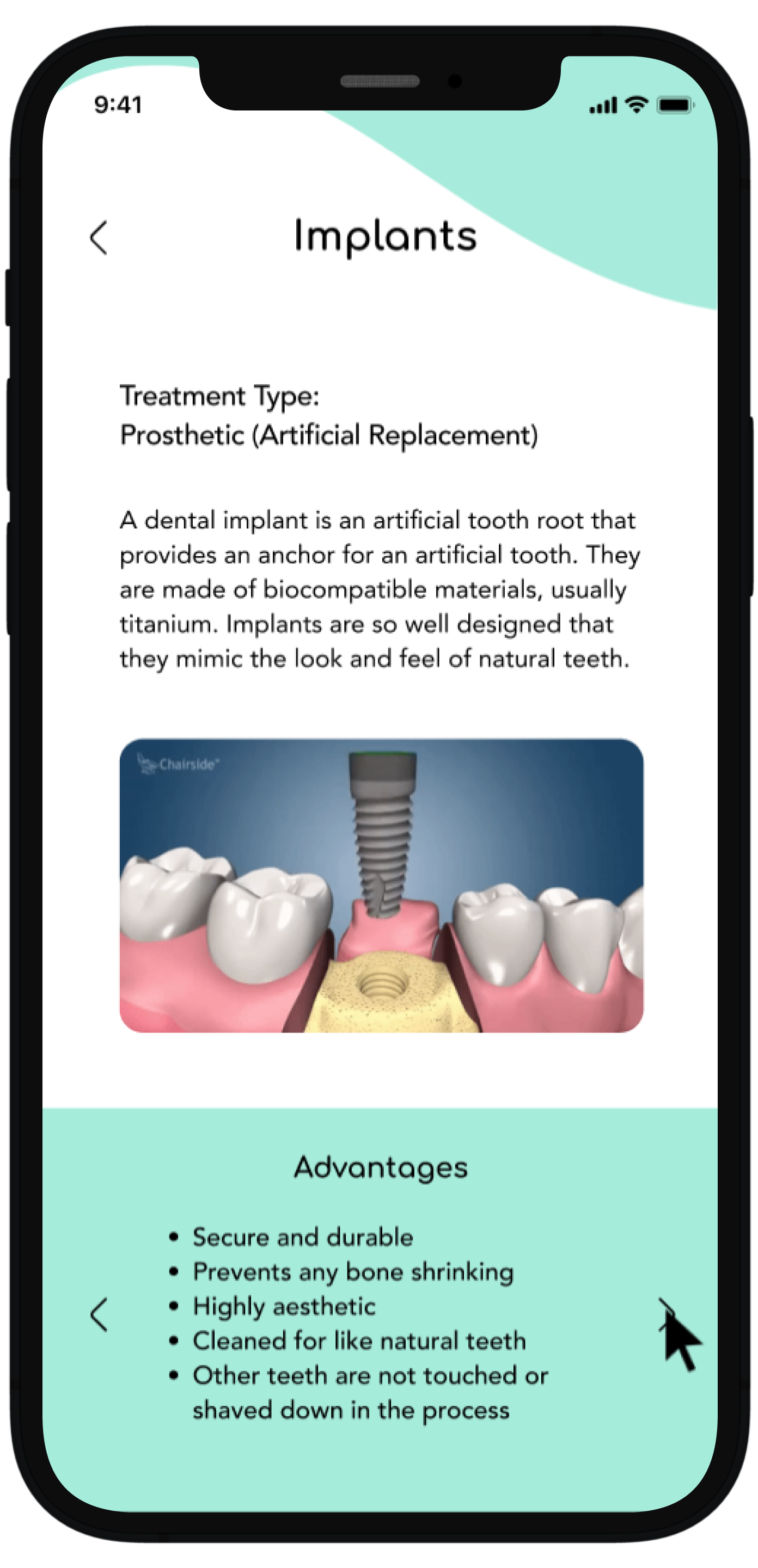 This is the final page of the flow which details the implant procedure and at the bottom it utilizes the same structure seen in previous flows where the user can toggle left or right in a carousel and gain more information