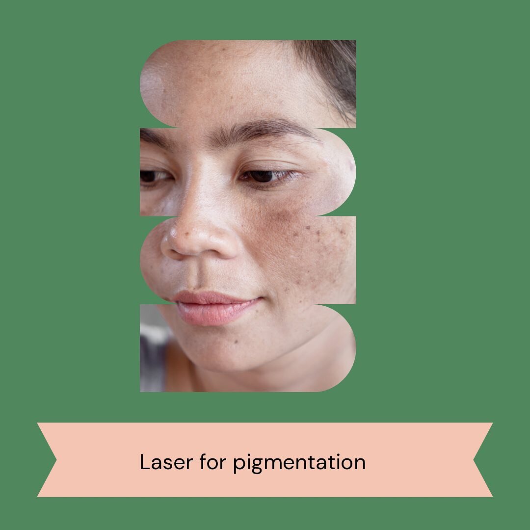 Pigmentation laser has been extremely popular in clinics since the introduction of my new Revlite laser. The results are impressive and most of all it is very safe and effective. Please ensure you have a recent skin check within 12 months before book
