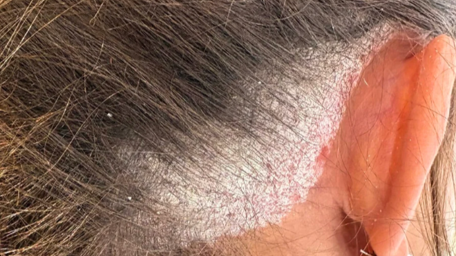 Psoriasis 101