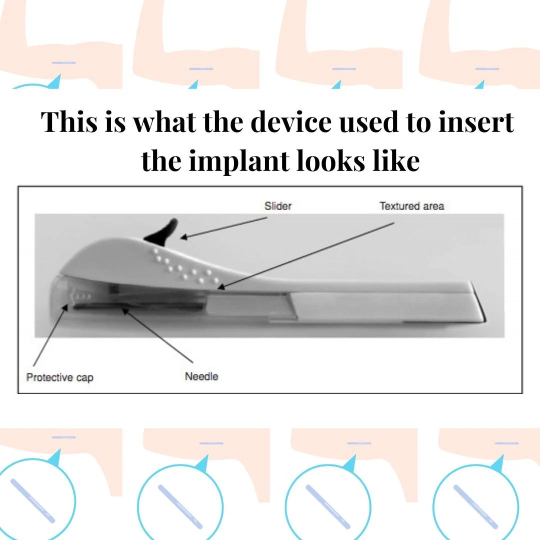 Implant Insert I've had the contraceptive implant, here's what to expect. — The SuPer ...
