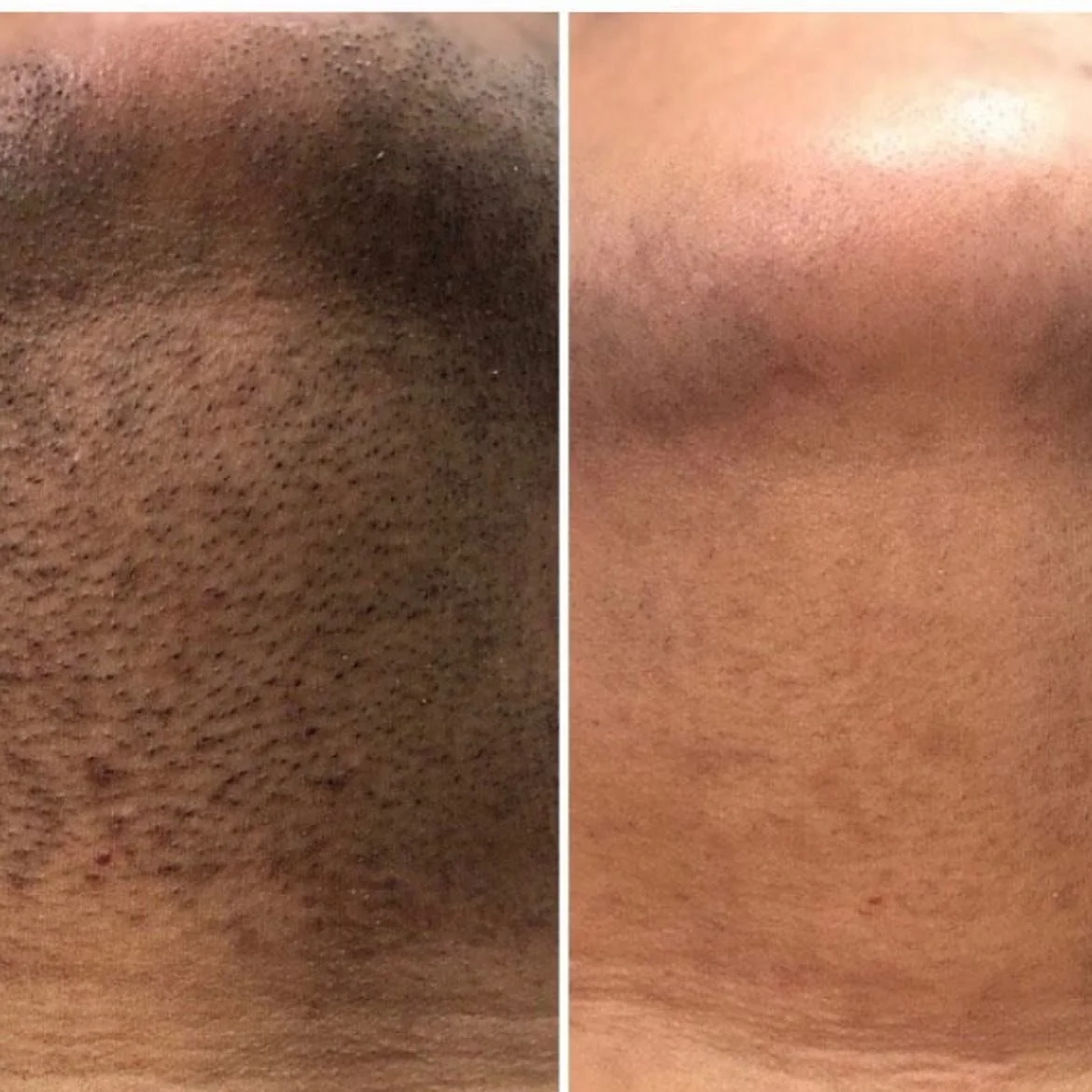 Before & after (chin)