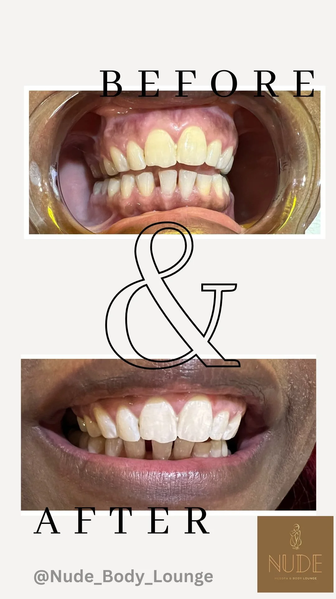 teeth Whitening B&A.jpg