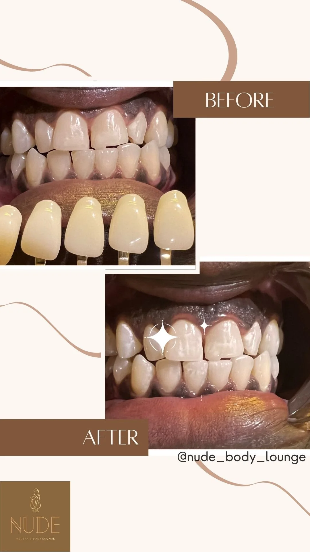 teeth Whitening B&A (1).jpg