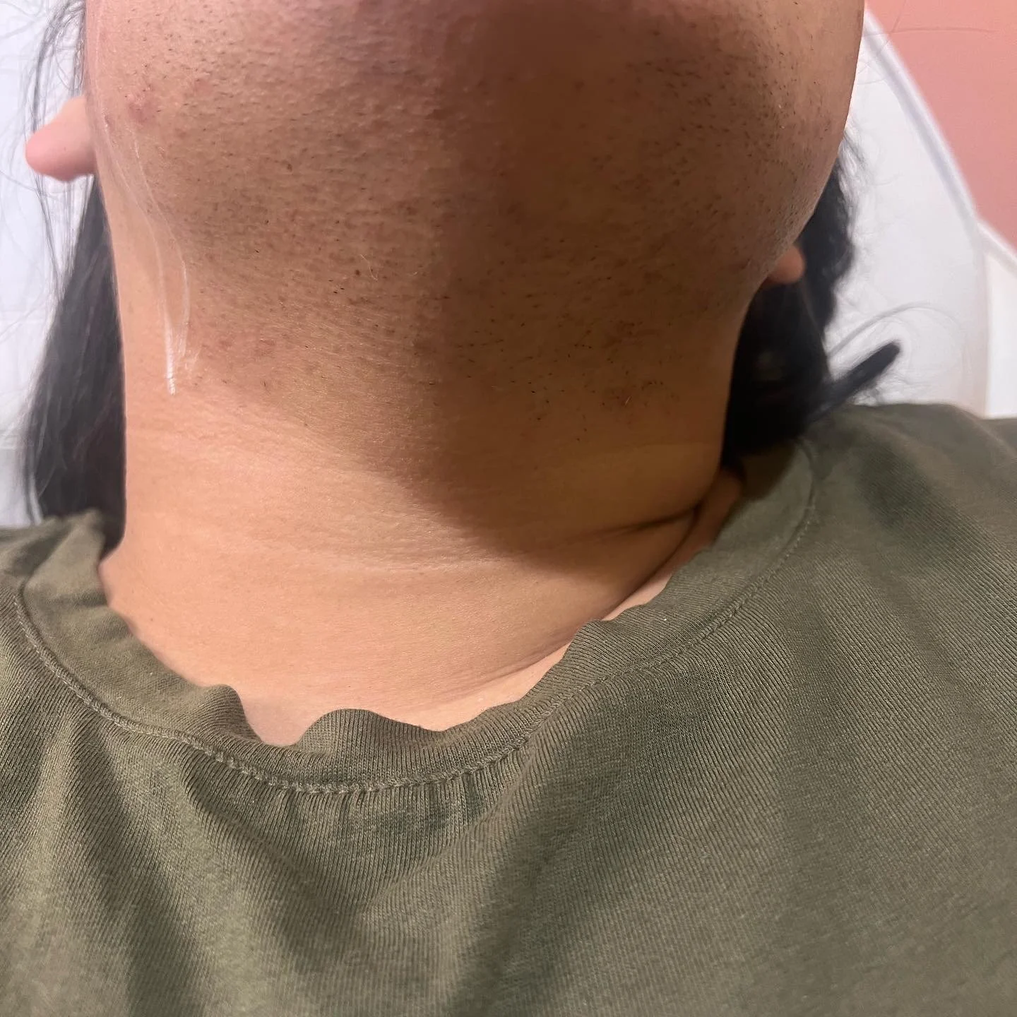 Before 2nd treatment