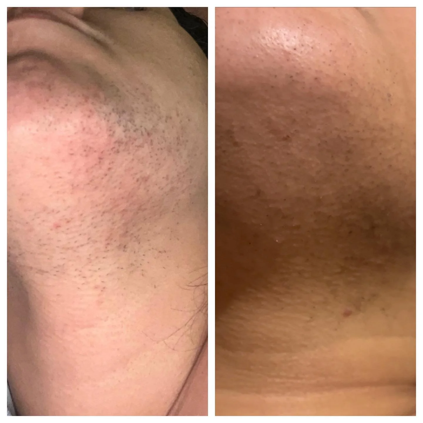 Before & after (chin)