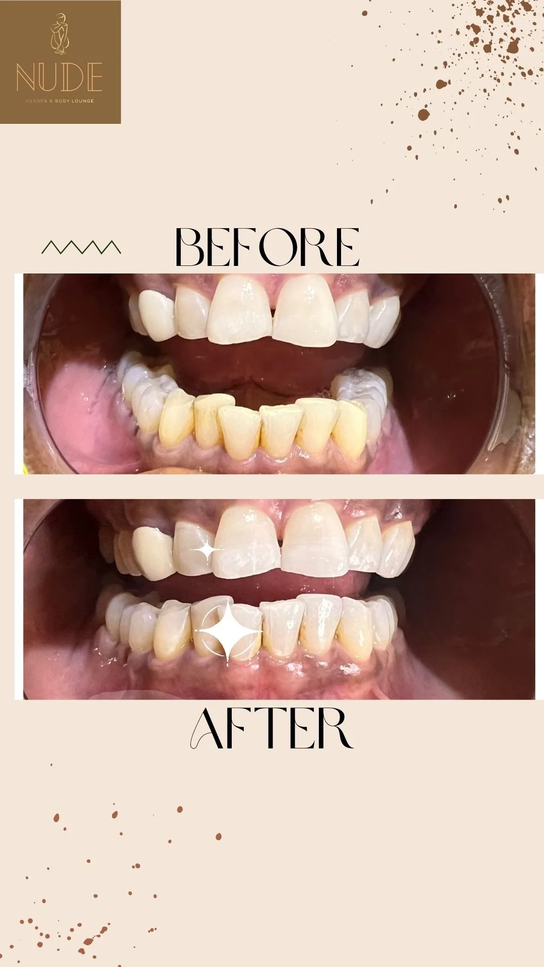 teeth Whitening B&A (2).jpg