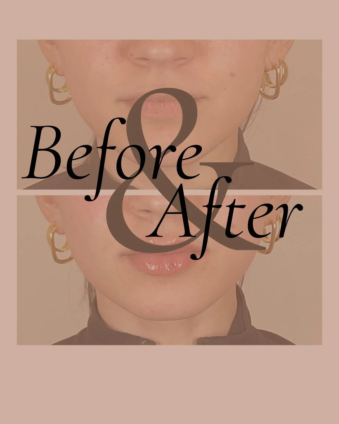 A gorgeous set of lips from Nurse Injector Amy! If you&rsquo;re looking for a natural looking pout our Nurse Injectors perfect for you! Our team focuses on lip enhancement that brings out the natural beauty in your lips. ______________________

>
