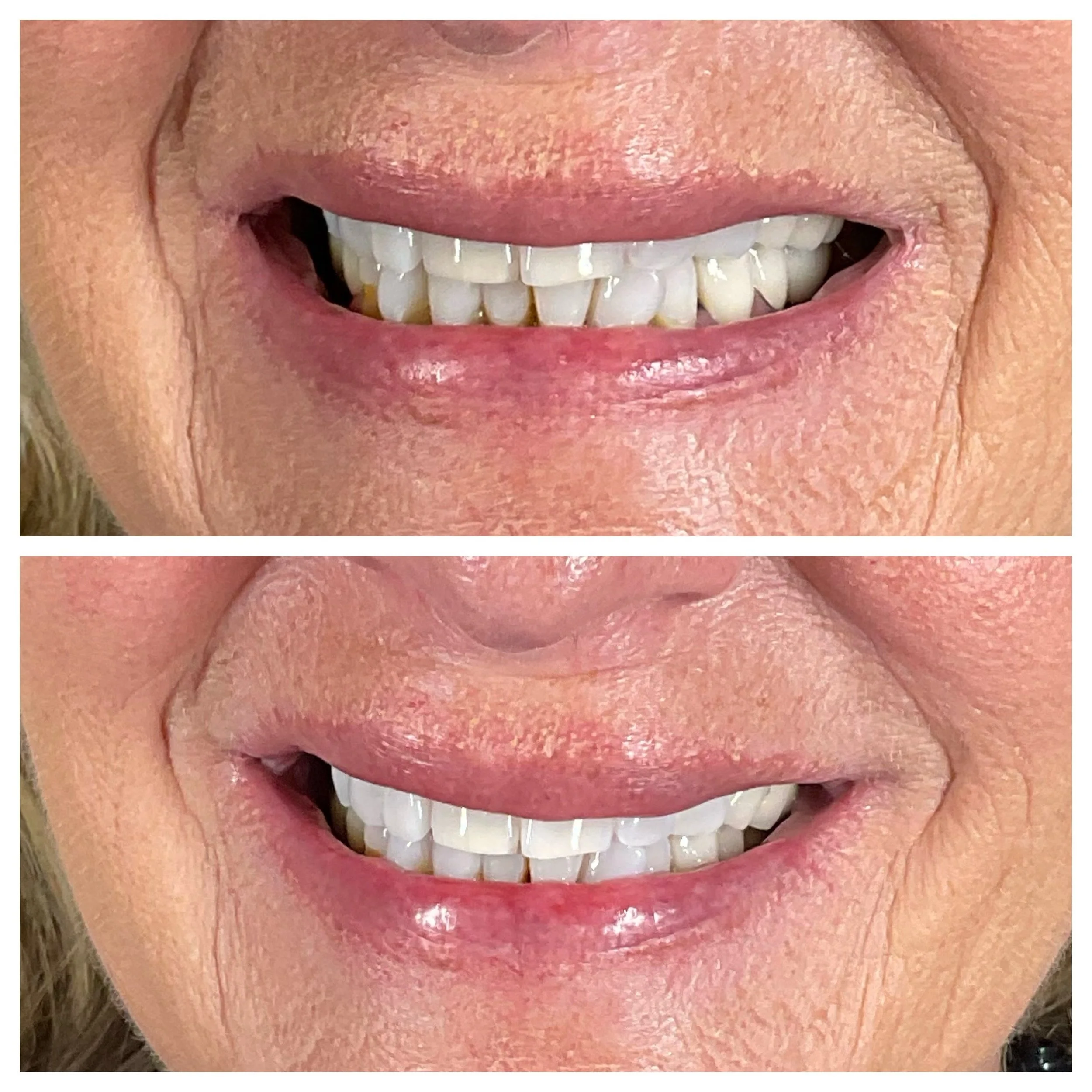Brighten up those pearly whites with our new teeth whitening service. This treatment uses an enamel safe gel to whiten your teeth up to 4 shades! ______________________

>
>
>
>
>

BOOK WITH AAC👇🏼
📧 info@aaclookyoung.com
💻AACLookYo