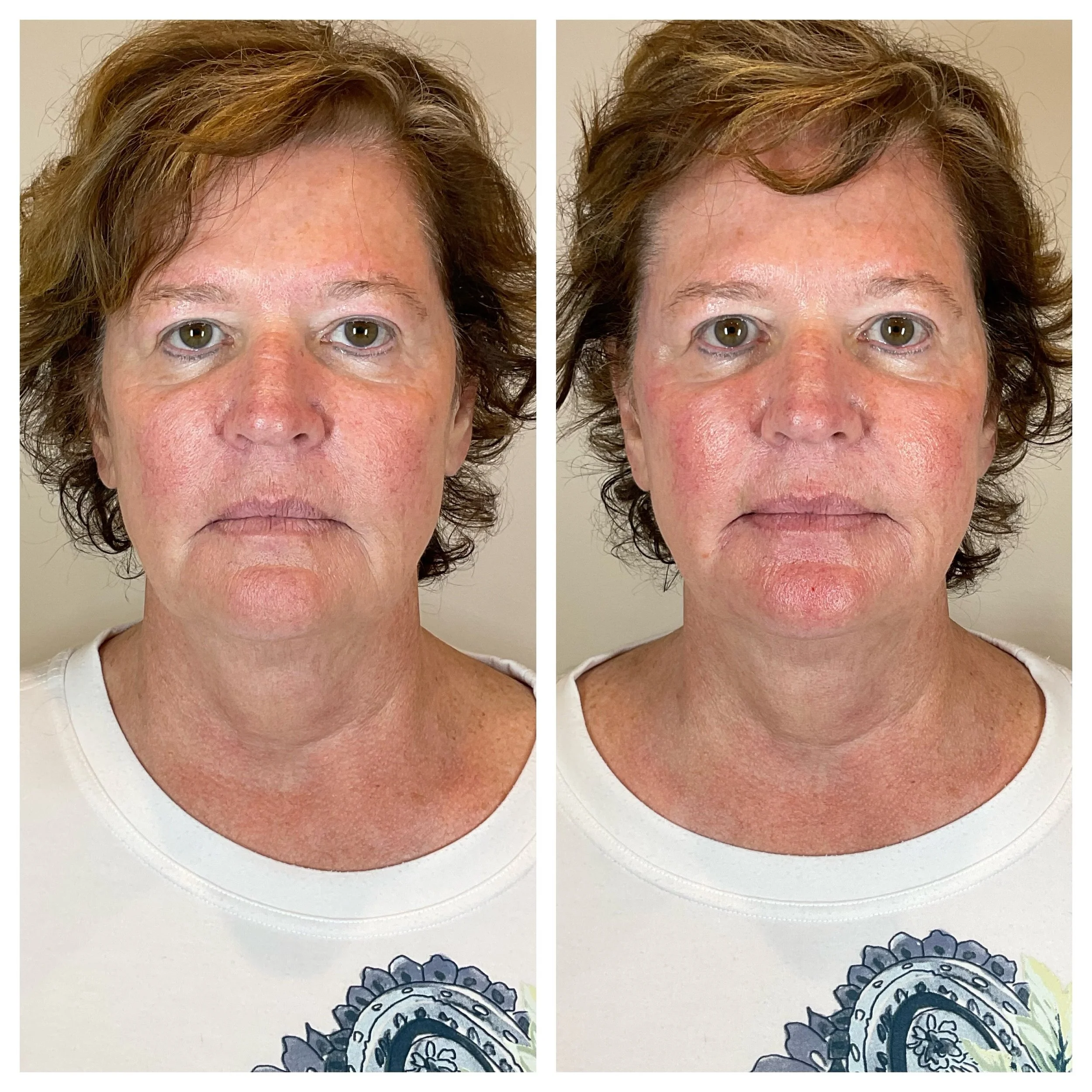 Obsessed with these results? Same. 😍 

This is what happens when you trust your face to someone who truly gets it &mdash; swipe through to see some of Amy&rsquo;s most recent filler transformations.

Here&rsquo;s the exciting part: Juv&eacute;derm D