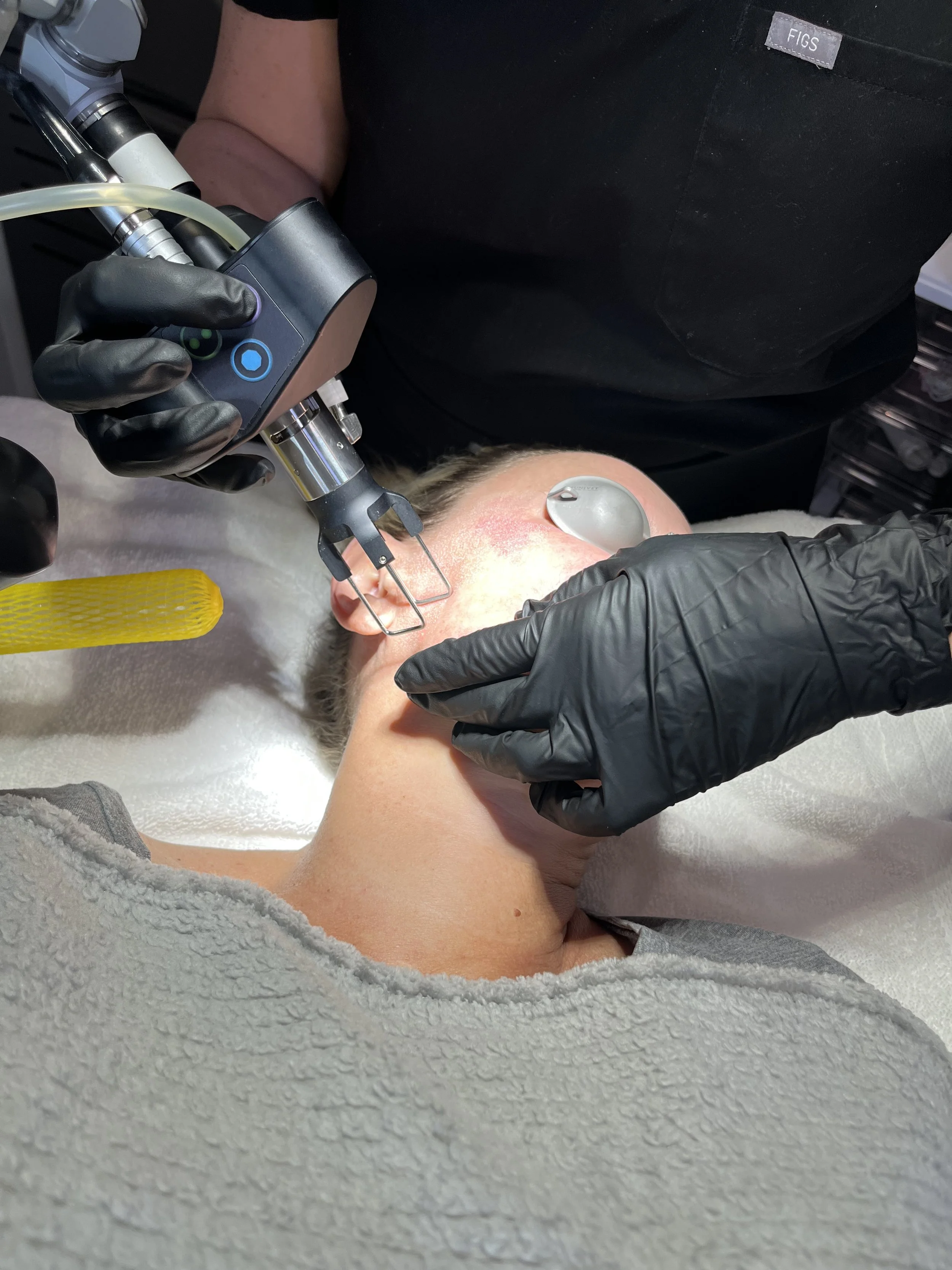 Laser facial treatment