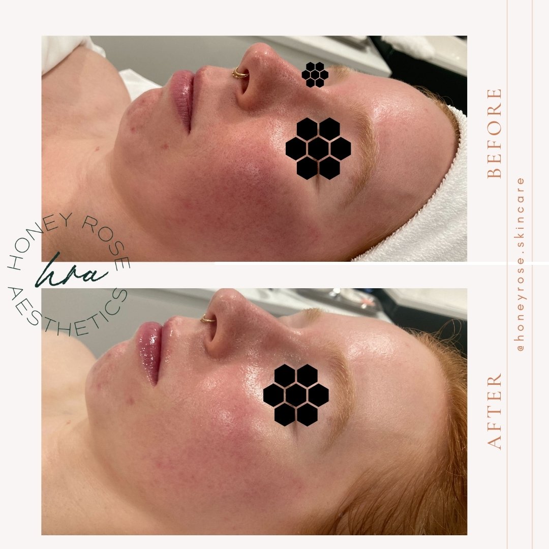 If you have an event coming up and are ready to GLOW 🤩, this is the treatment for you!

This is before and directly after a Glo 2 Oxy-Geneo Facial and it just shows you how instant some results can be! Her Estie Bestie used The Geneo Retouch OxyPod 