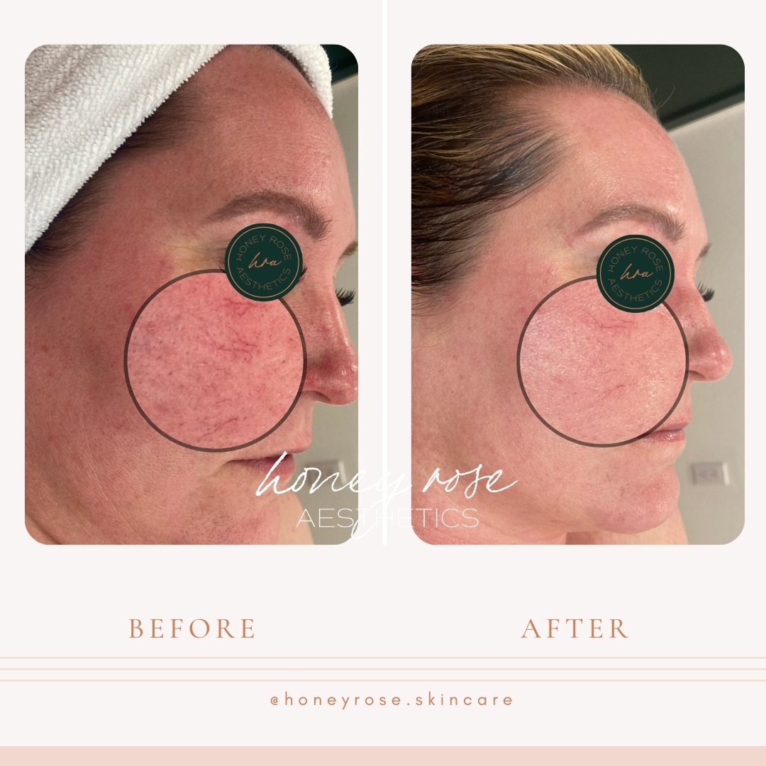 Rosacea + DMK = MAGIC!! 
These amazing results are after 1 DMK treatment, yes.... just 1. She came to us hoping to improve her overall redness, wanted to add life back to her skin and expressed she was self conscience of her broken capillaries, also 