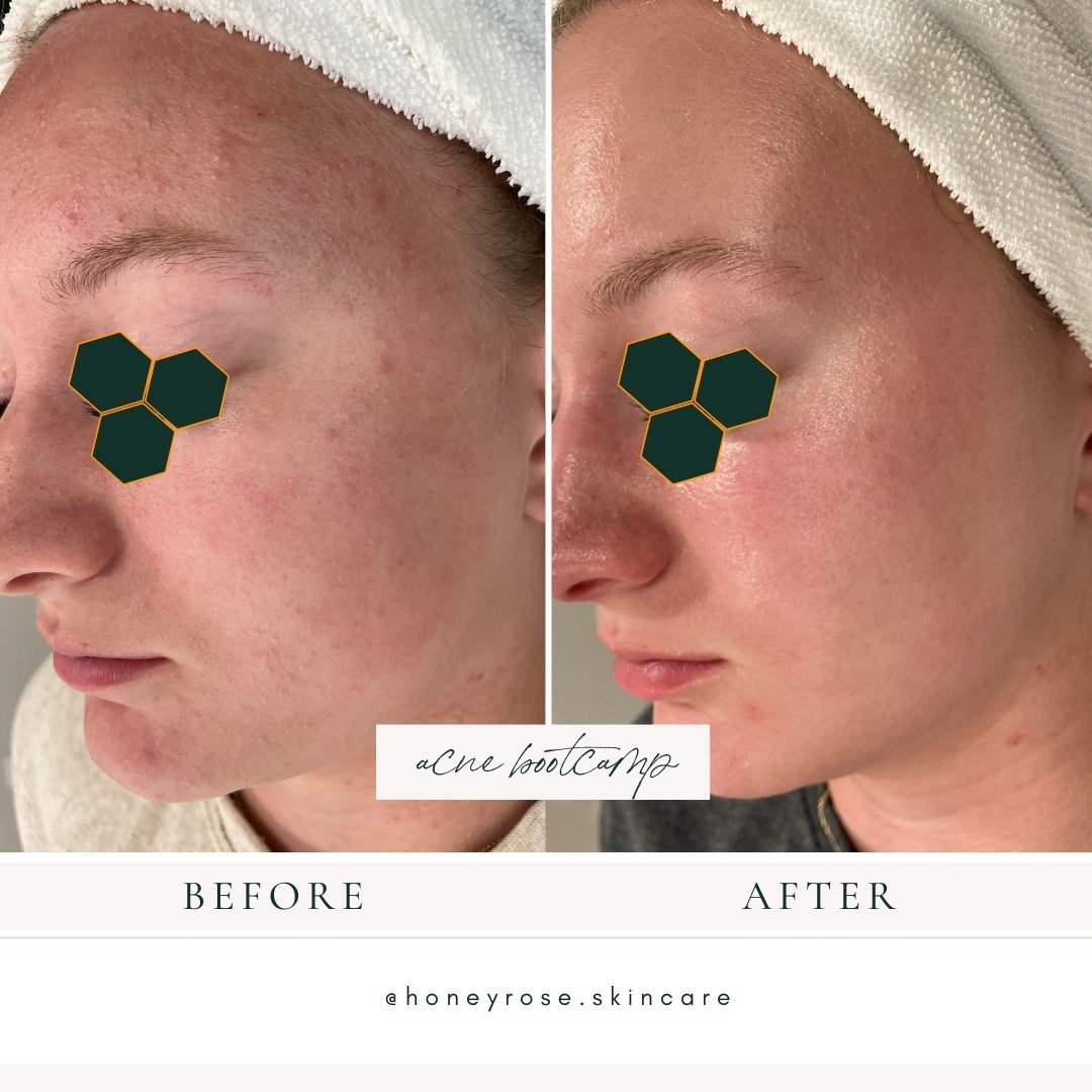 All eyes on this skin transformation! 👀 

Our client went from struggling with acne to achieving clear, radiant skin thanks to our effective skincare solutions. ✨

And guess what? You could be next! Introducing our newly revamped Acne Boot Camp Prog