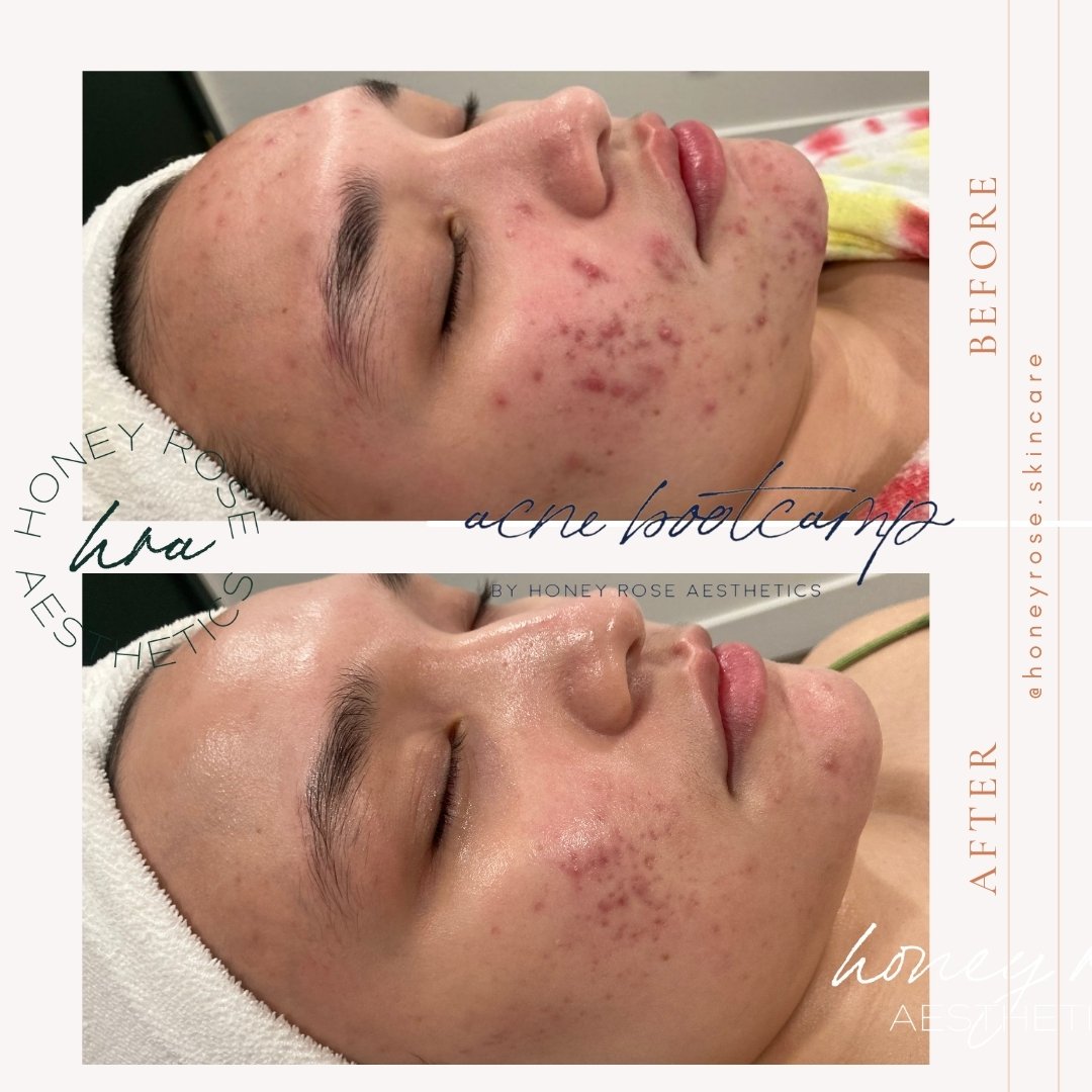 Her dream skin is coming in...🤩

Acne Boot Camp is a commitment, and she's done just that! 

Not only do the consistent treatments/extractions help, but her home regimen really helps make her dream skin come true! You can see the redness faded, cong