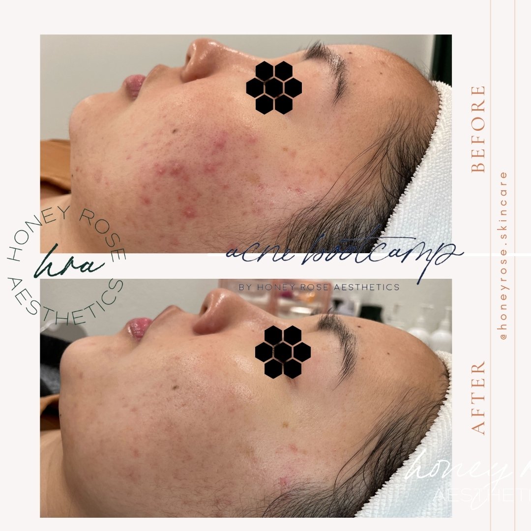 Can we take a moment for these results...😍 Her redness, congestion, and pores practically diminished!

In just two months our beautiful client and her Estie Bestie achieved the skin of her dreams as a team🫶🏻

The home regimen our Acne Boot Camp cl