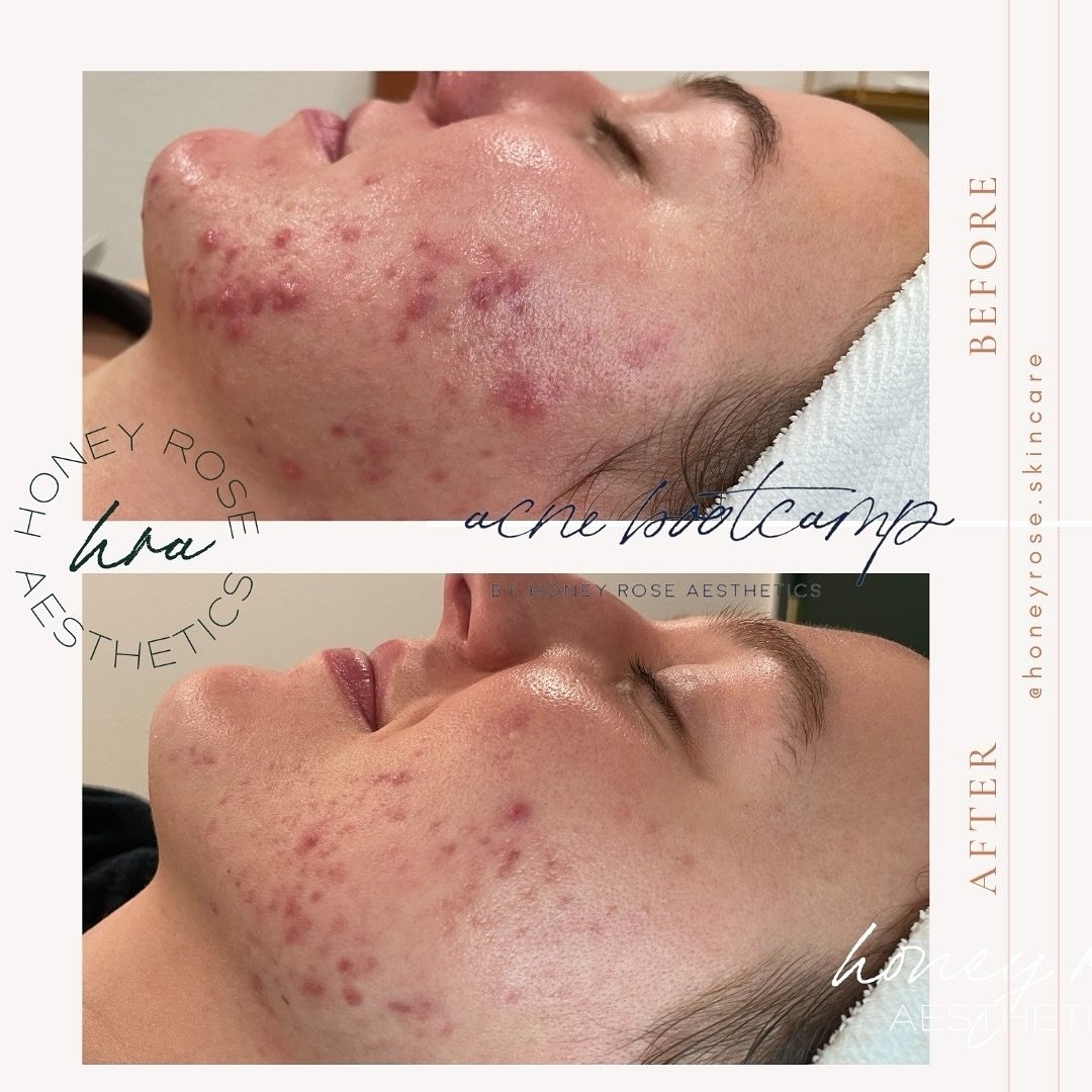 We love seeing our beautiful clients confident in their new skin! Acne and inflammation gone now on to scar revision. We are so proud of our beautiful client for all her hard work, dedication and consistency. Teamwork makes the dream work.

💁🏻&zwj;