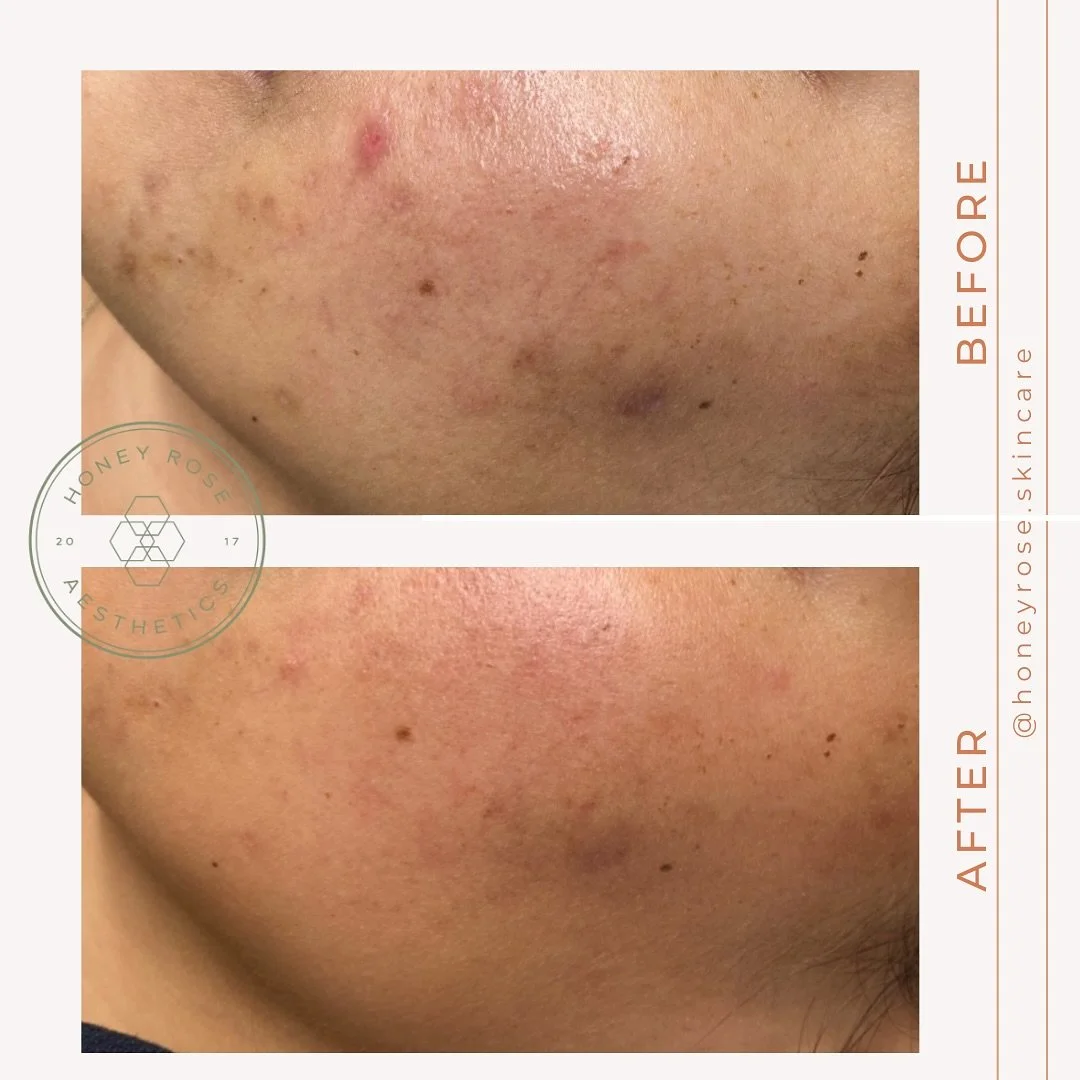 If you haven&rsquo;t booked your appointment for a TCA Peel, this is your sign. 🤩

A series of 3-6 peels is recommended depending on your skin and skin concerns, but the difference just 1 TCA peel has done for our clients is mind blowing!

This Babe
