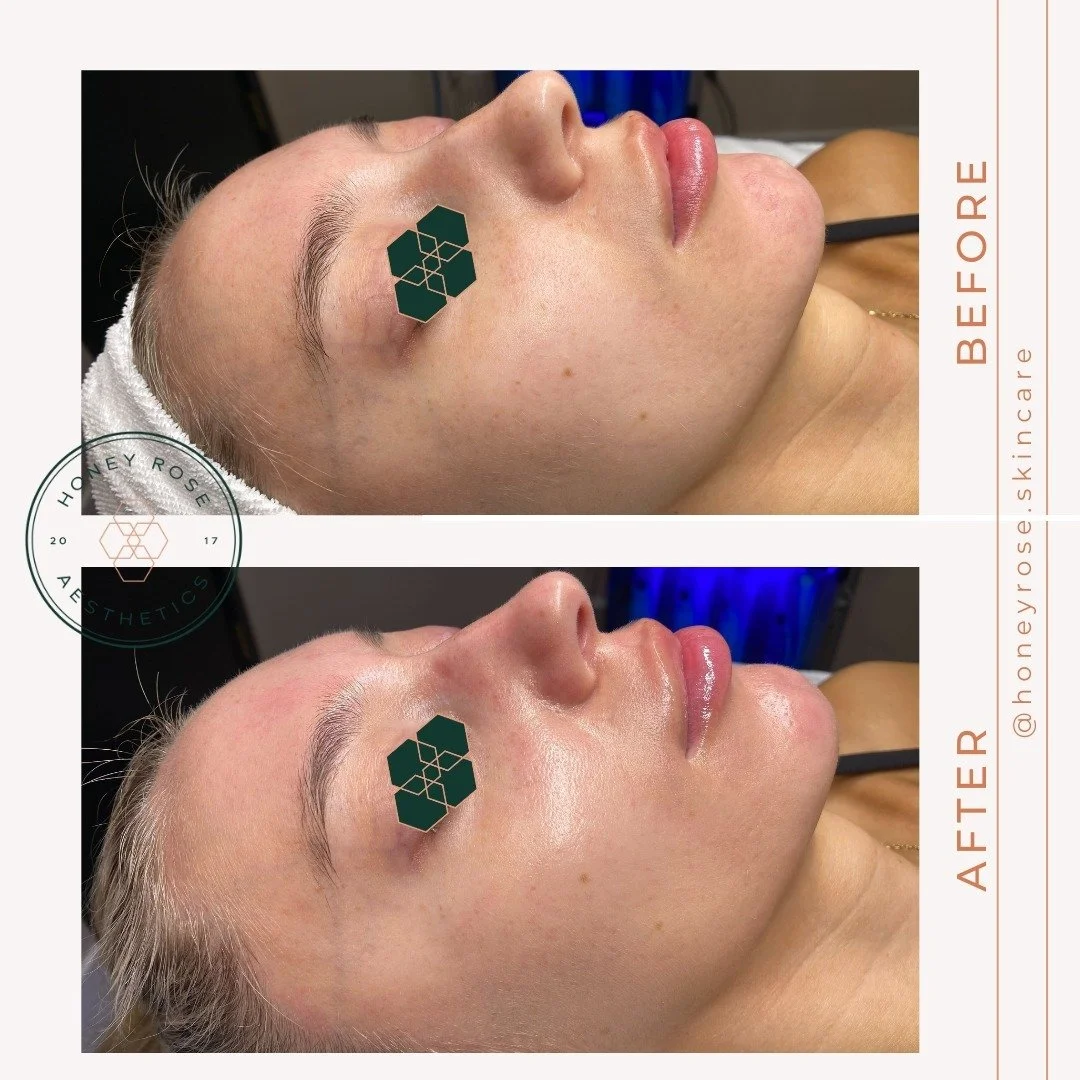 Want to shine as bright as this HRA Babe for the holidays?
Experience clearer, smoother, and more radiant skin with our customized HydraFacial treatments today! 

Each treatment is designed to cleanse, exfoliate, extract impurities, and hydrate your 