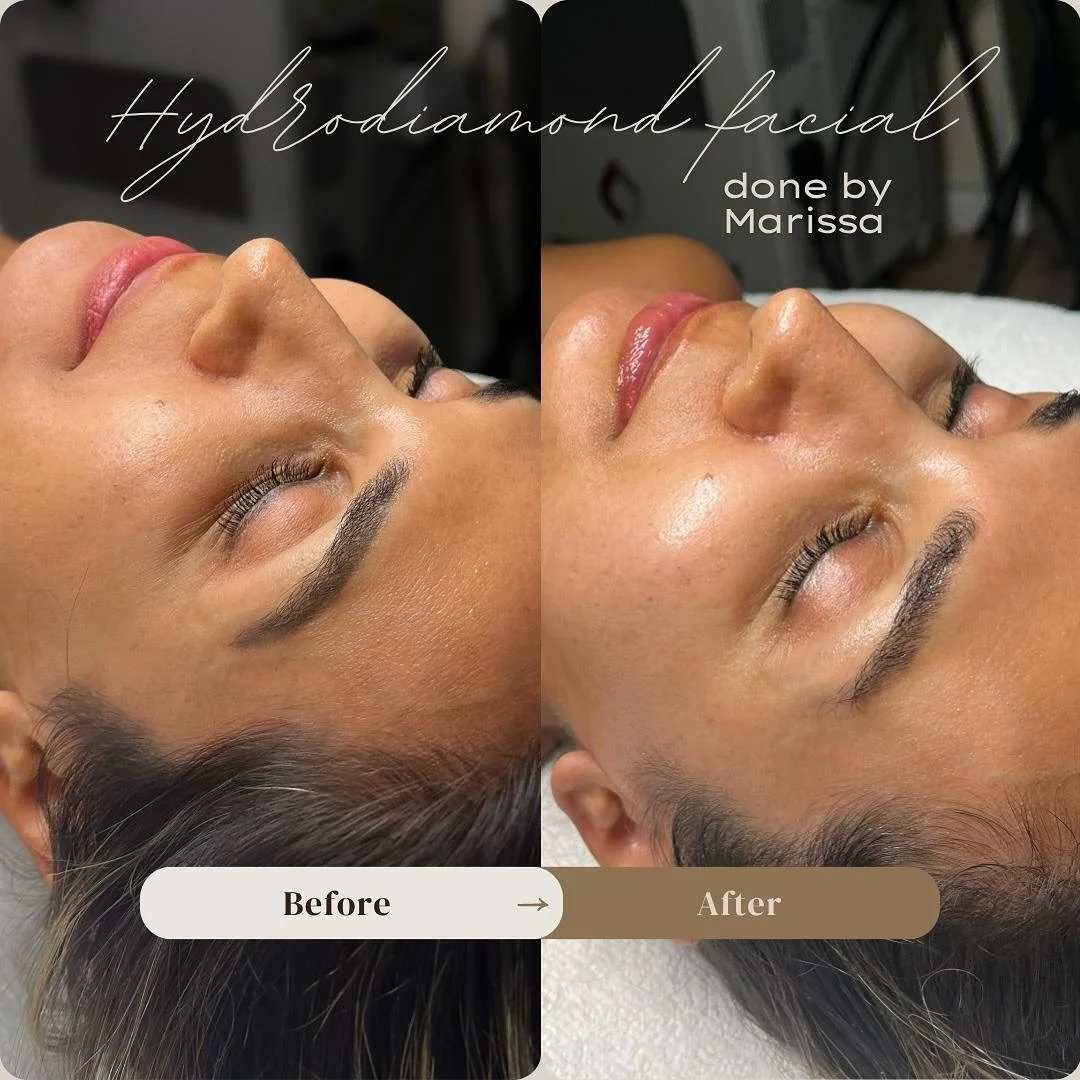 Not sure which treatment to choose when booking? ๐ค
HydroDiamond is always a great idea - it exfoliates, deeply hydrates, and leaves your skin glowing instantly โจ
Performed by our talented Marissa @forever.youthful.esthetics ๐ค
โจ Enjoy 10% off all
