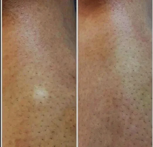 Vitiligo Scar camouflage tattooing