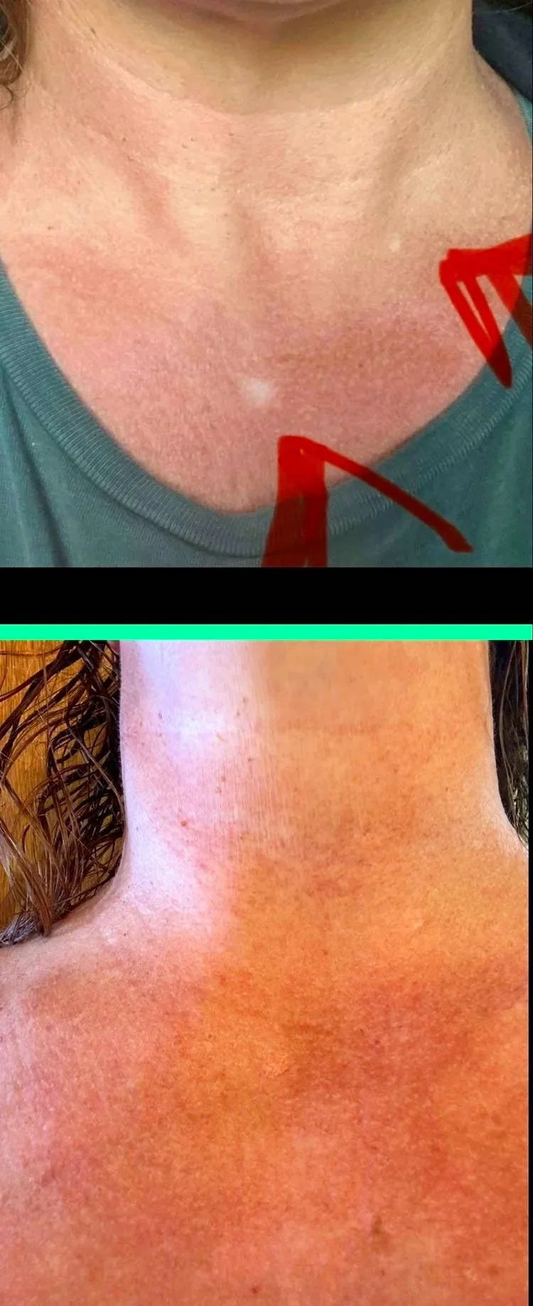 Corrected skin pigment on chest