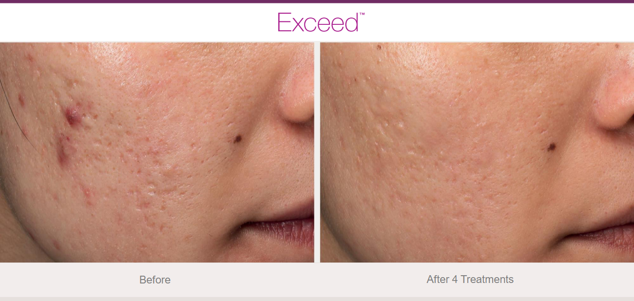 Side-by-side comparison of a person's cheek before and after four skincare treatments, showing reduced acne and skin imperfections.