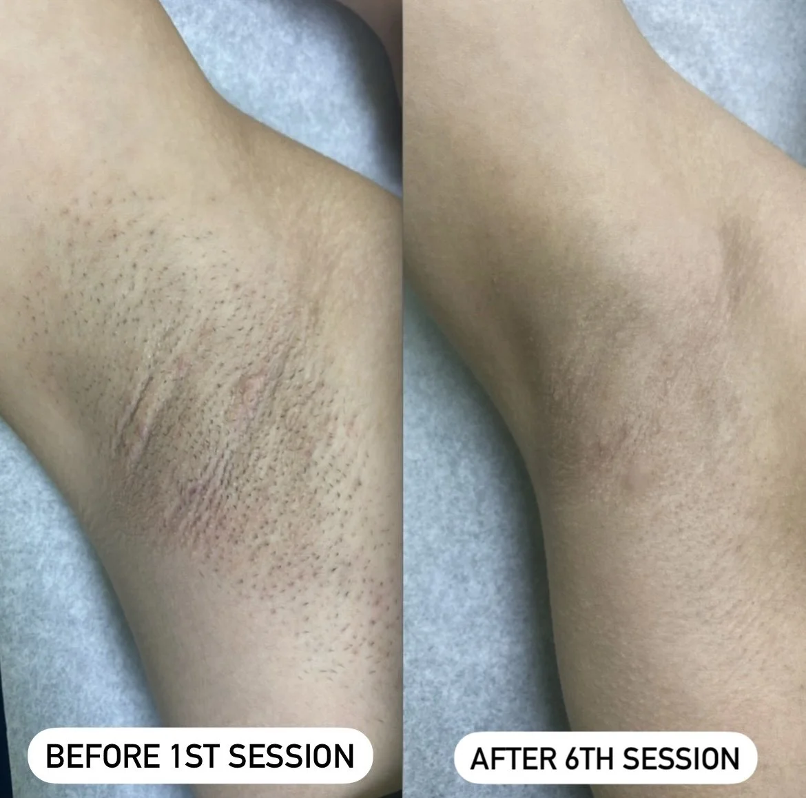 Side-by-side comparison of a person's underarm showing skin before and after six sessions of treatment. The left image is labeled 'BEFORE 1ST SESSION' and shows visible hair follicles, dark spots, and some skin irritation. The right image is labeled 'AFTER 6TH SESSION' and shows smoother, hair-free skin.
