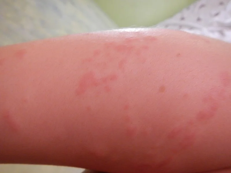 TMy arm, the morning of my episodde