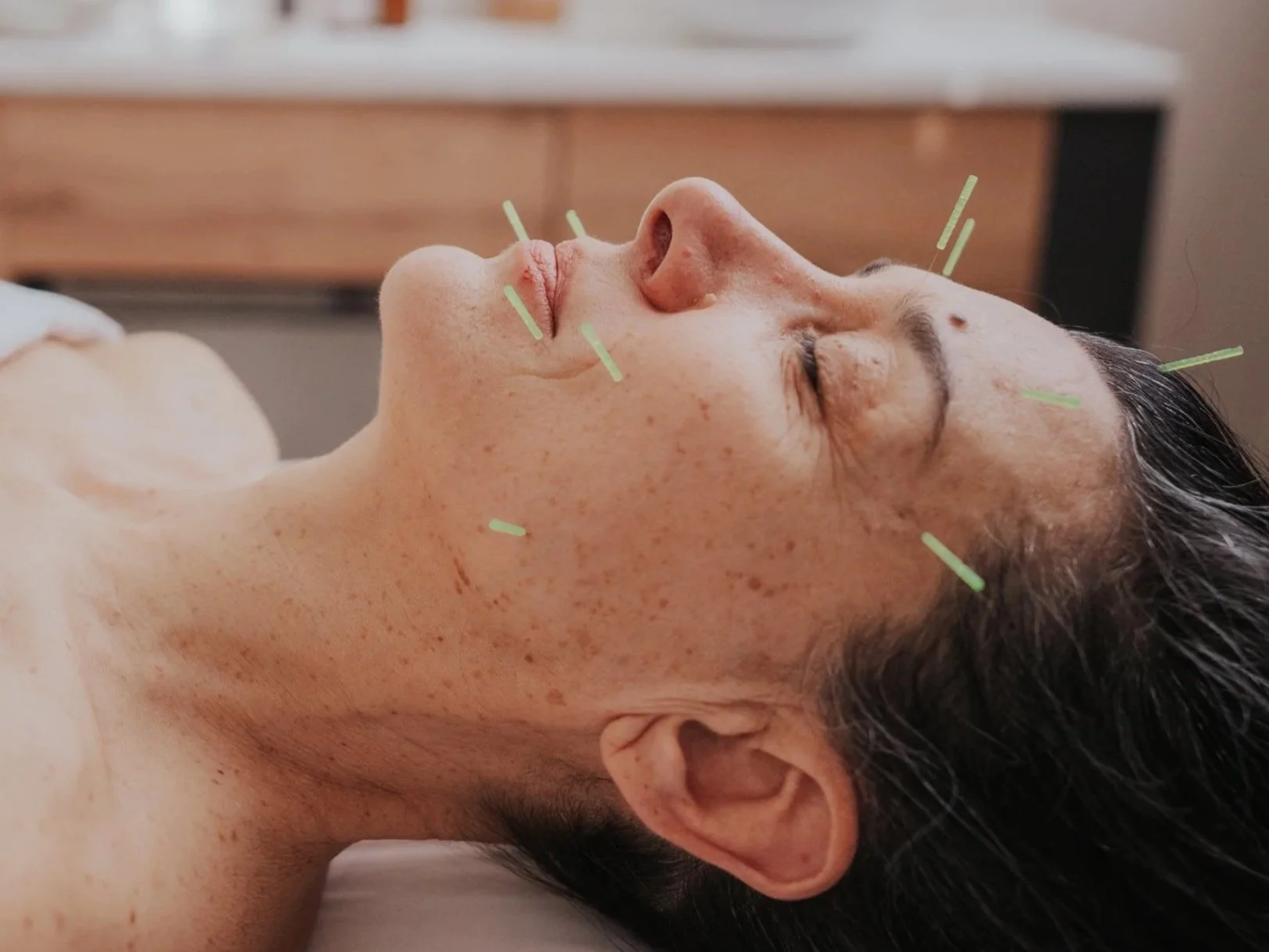 Facial Acupuncture