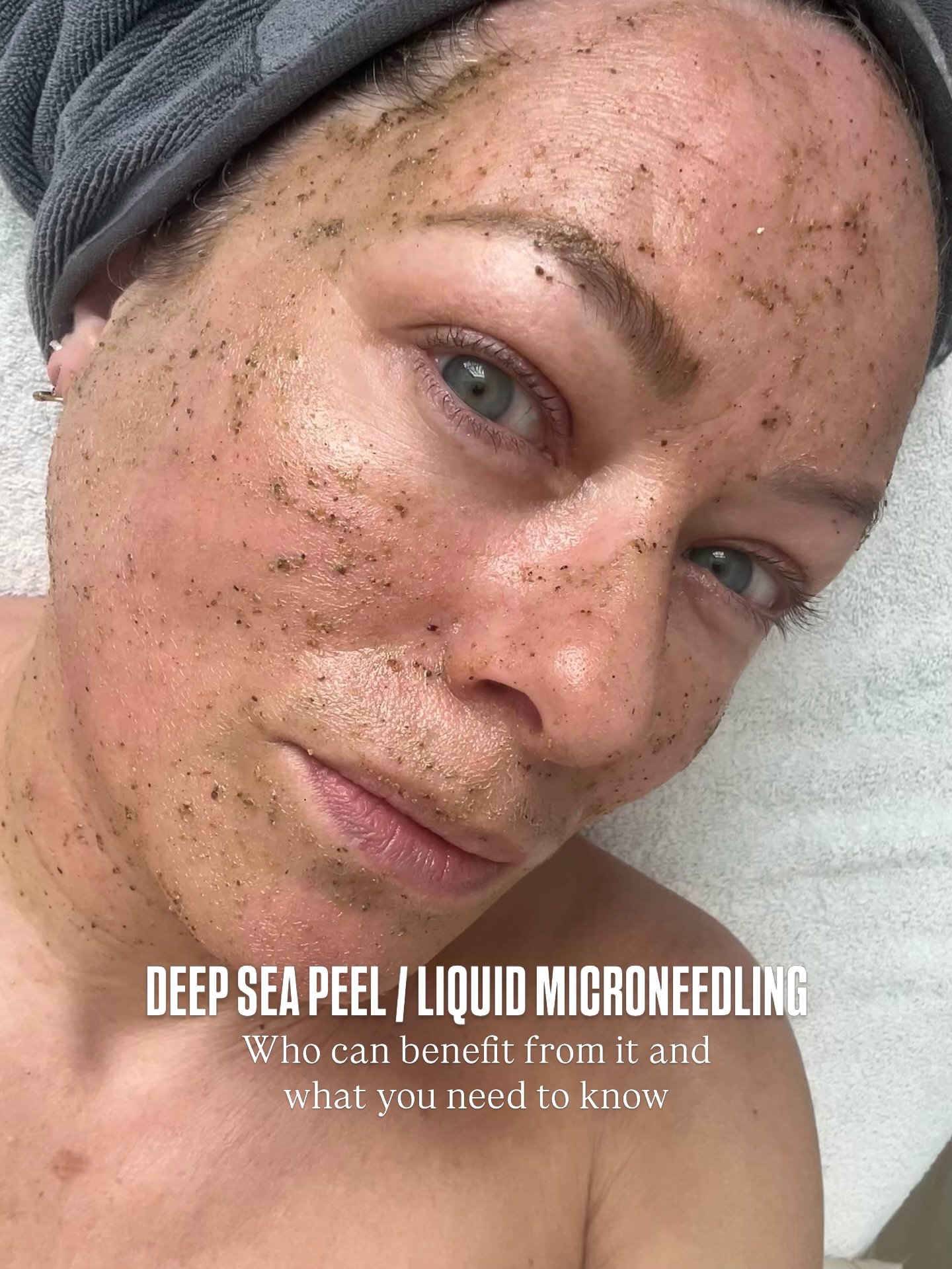 Swipe to see the full journey of the Cosmedix Deep Sea Peel&mdash;from start to finish. Often called liquid microneedling - This treatment uses natural spicules (instead of needles) to stimulate collagen and boost cell turnover, leaving your skin fee
