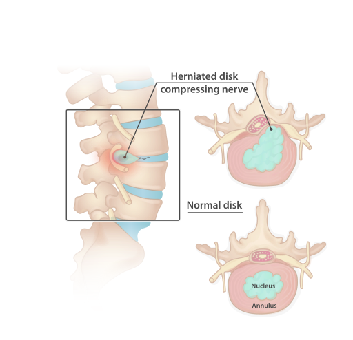 A Physio’s Guide To Lumbar Disc Bulges - How to Know if You Have One ...